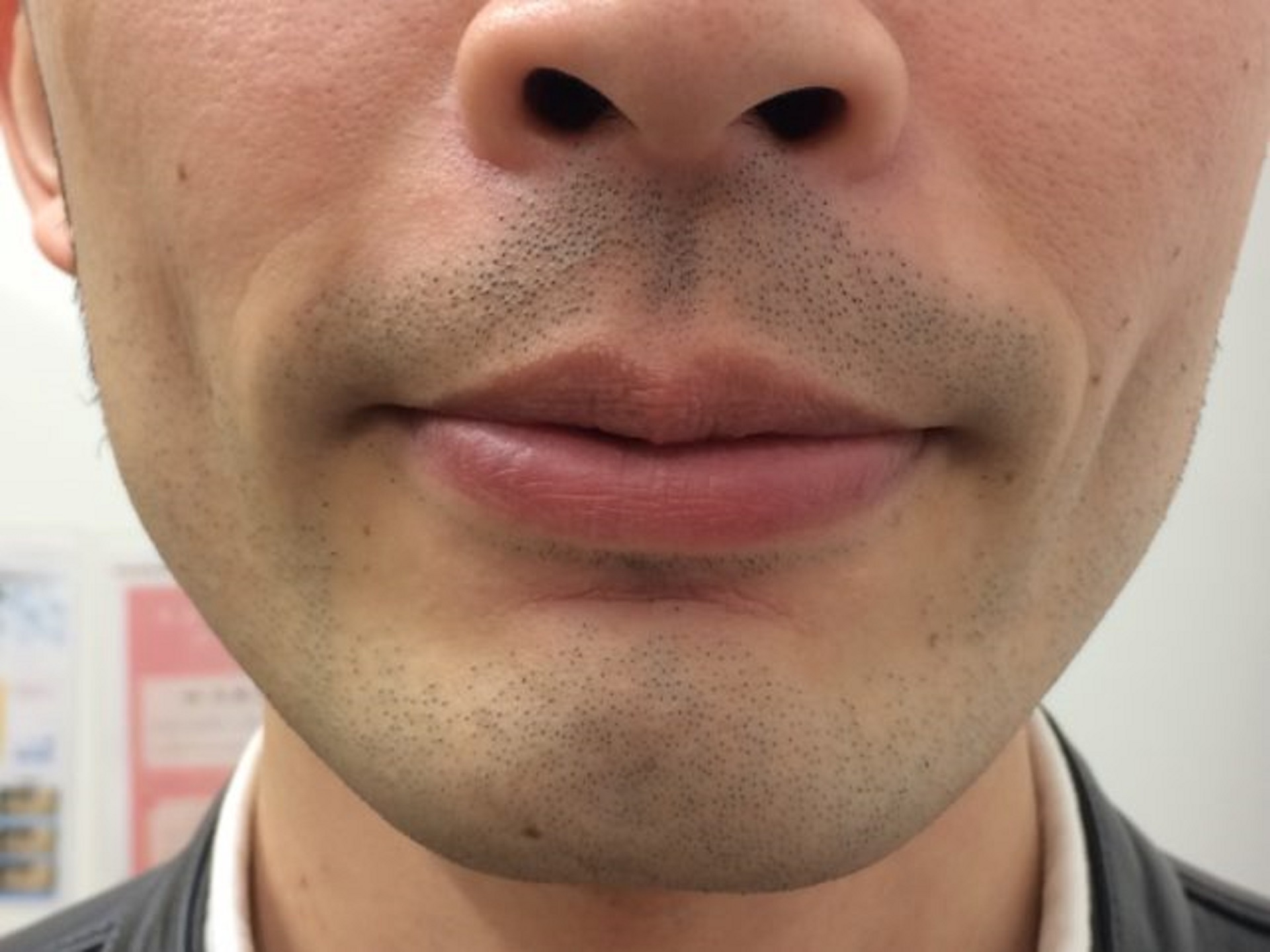 ヒゲ脱毛2回目 少し減った 効果はまだ疑問レベル 体験談 メンズ脱毛レポート