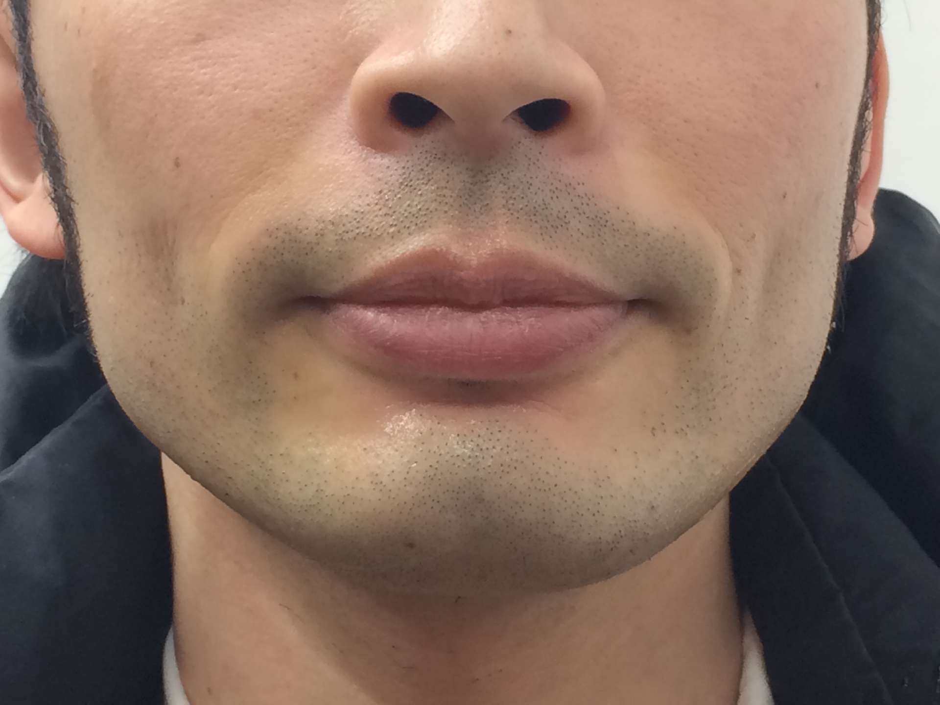 ひげ脱毛4回目を終えた直後の口周り