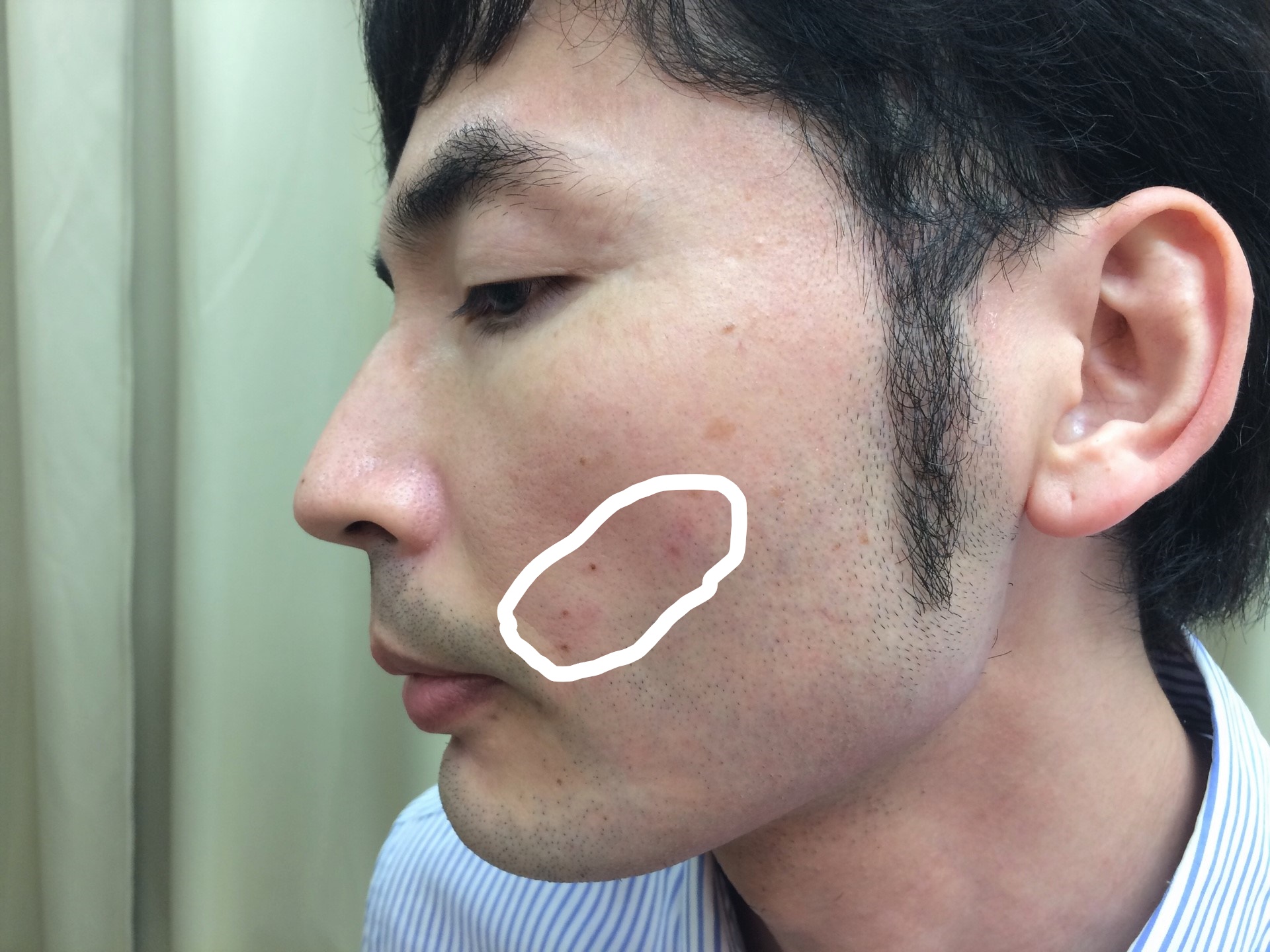 頬ひげ脱毛の施術直後