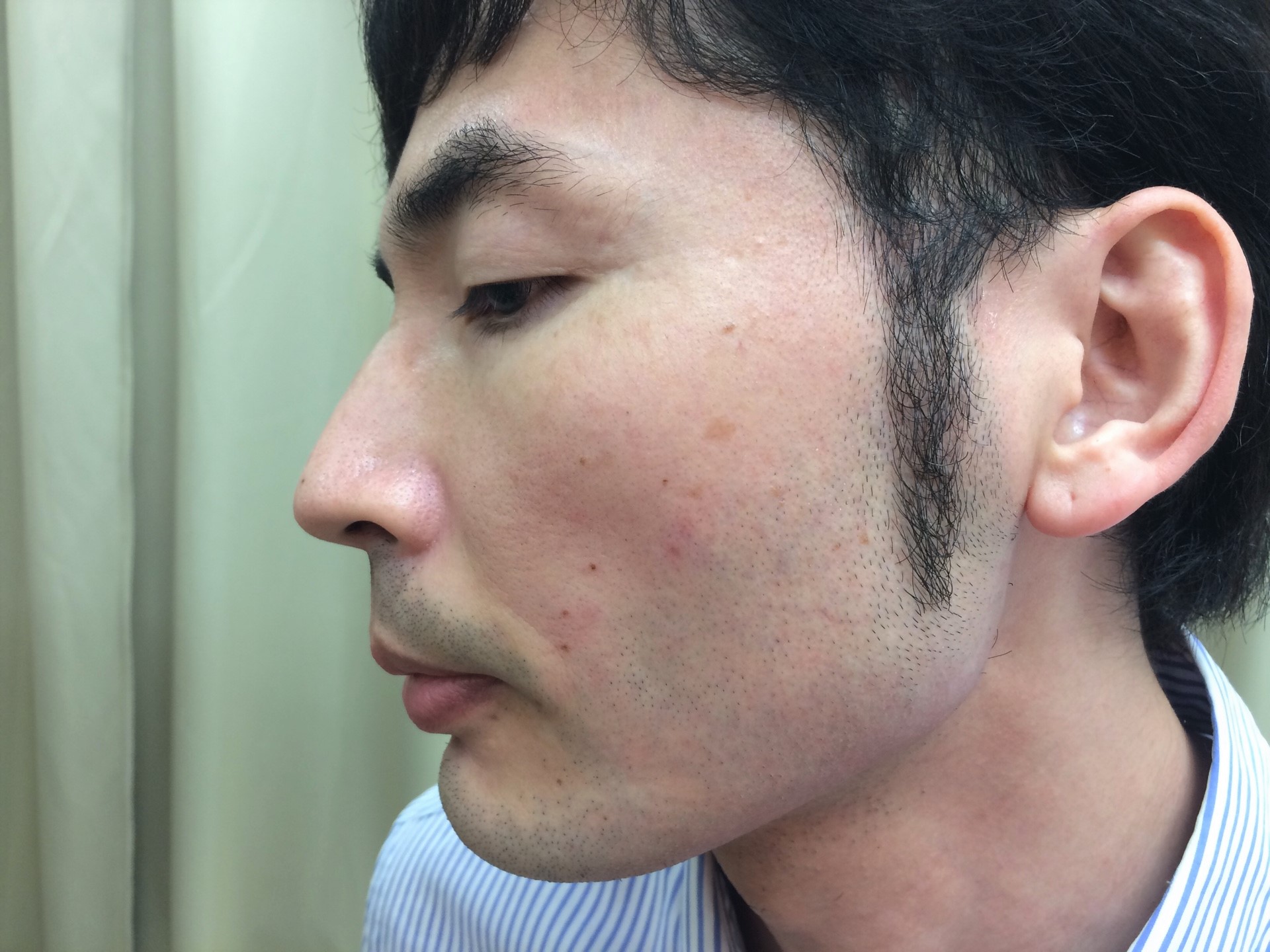 頬ひげ脱毛の施術直後の写真