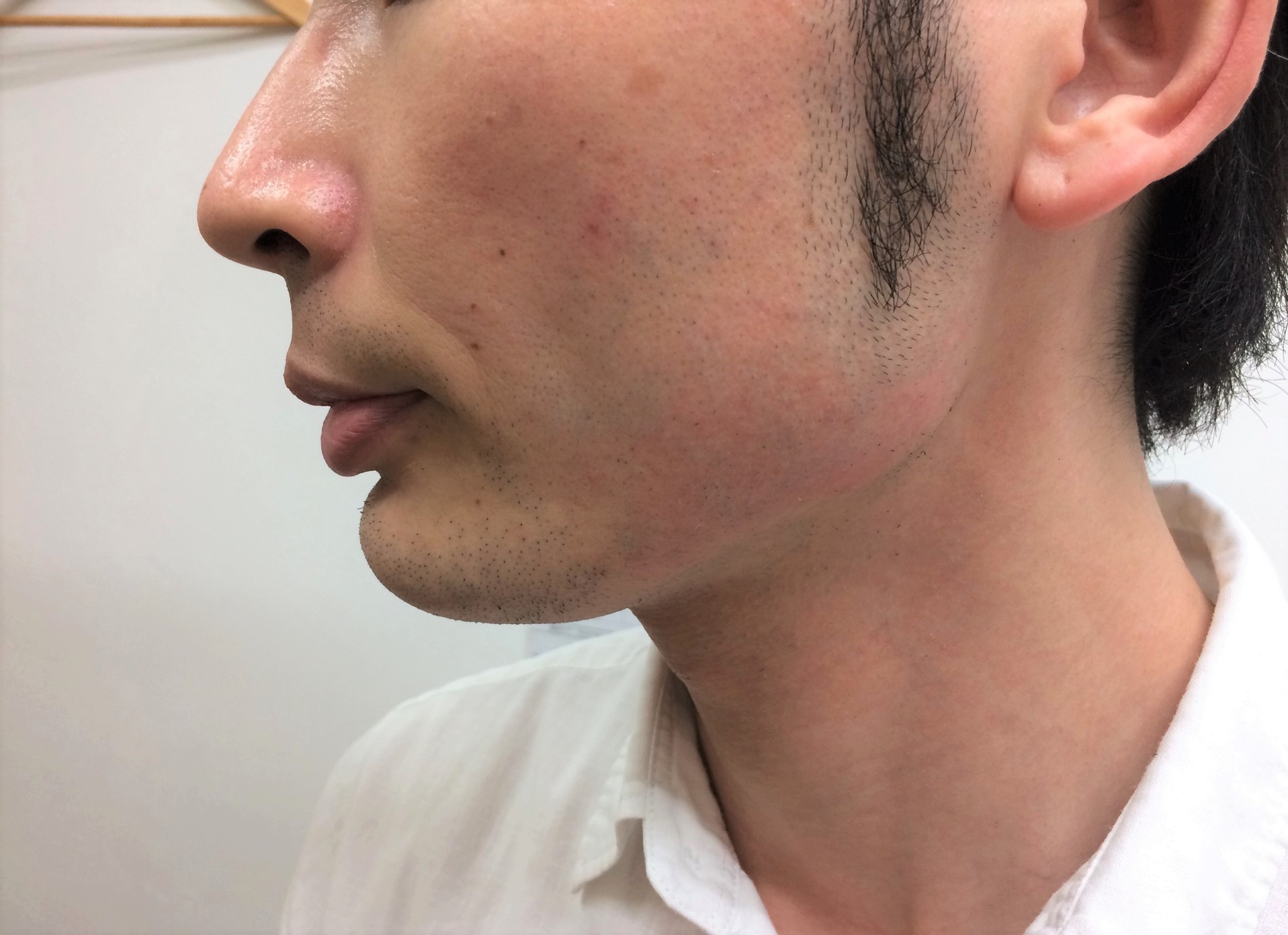 頬ひげ脱毛2回目の施術後