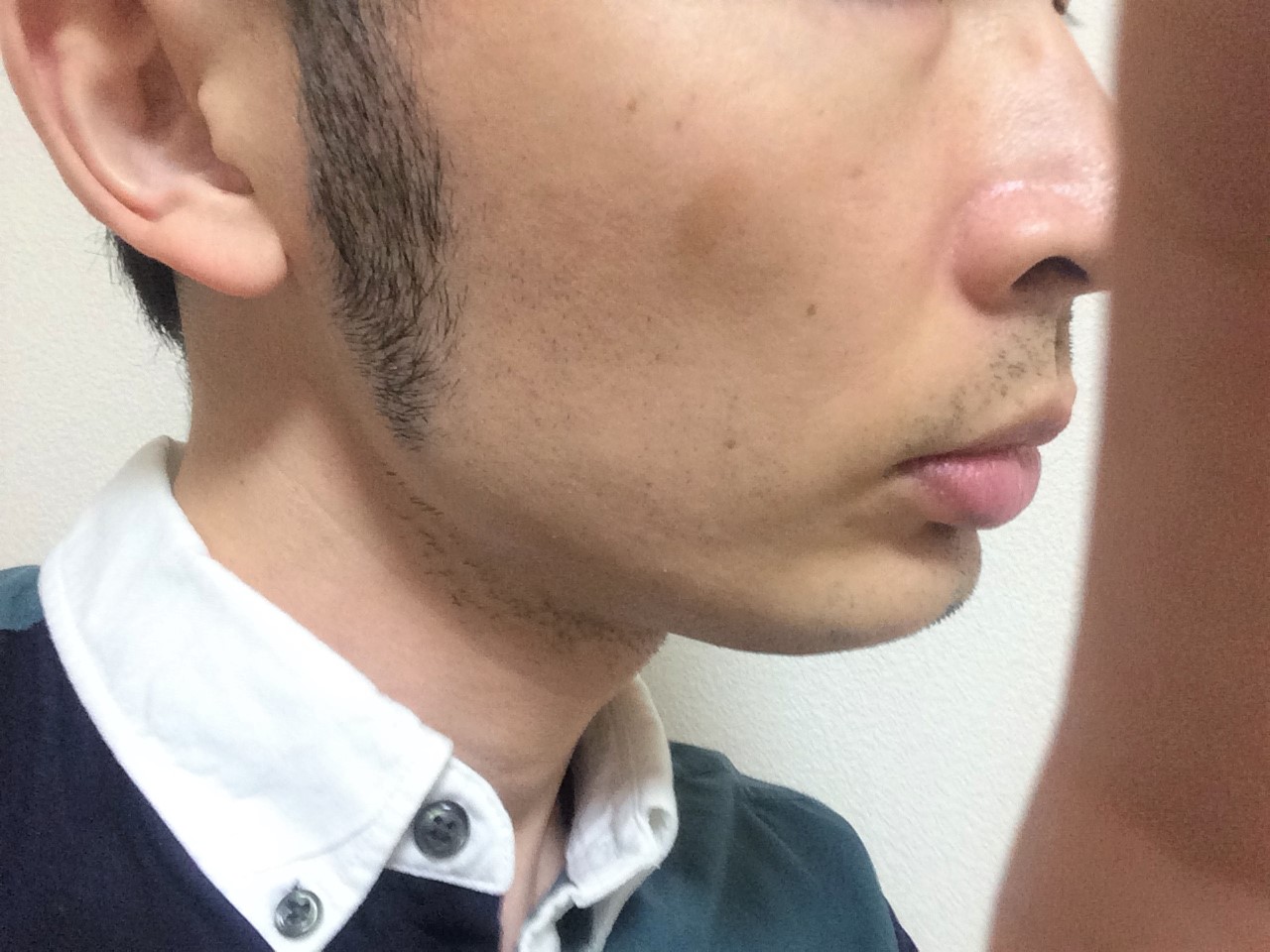 頬ヒゲ脱毛4回目 もみあげ周辺も抜けたものの副作用大 体験談 メンズ脱毛レポート