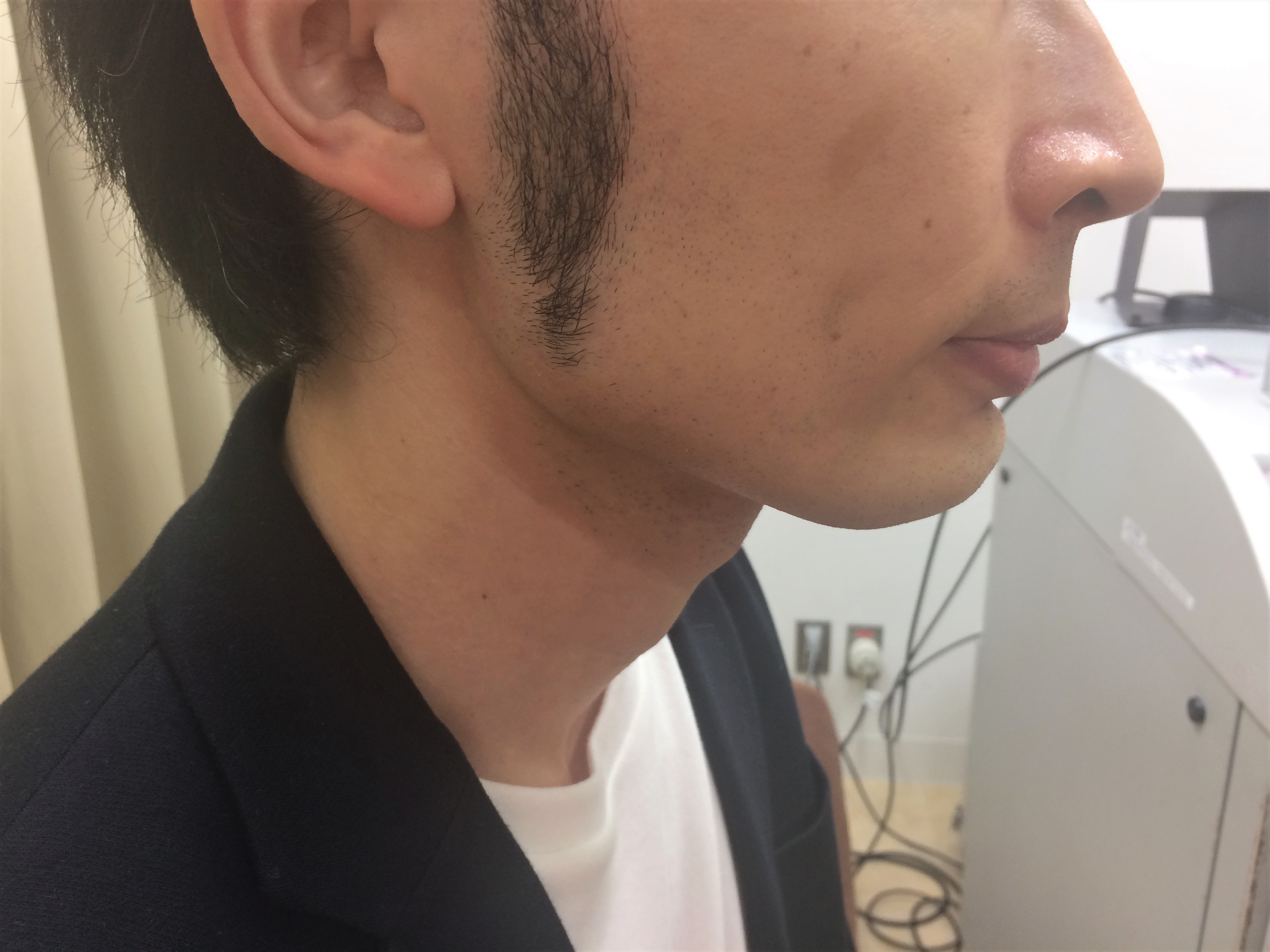 頬ひげ脱毛4回目の施術前