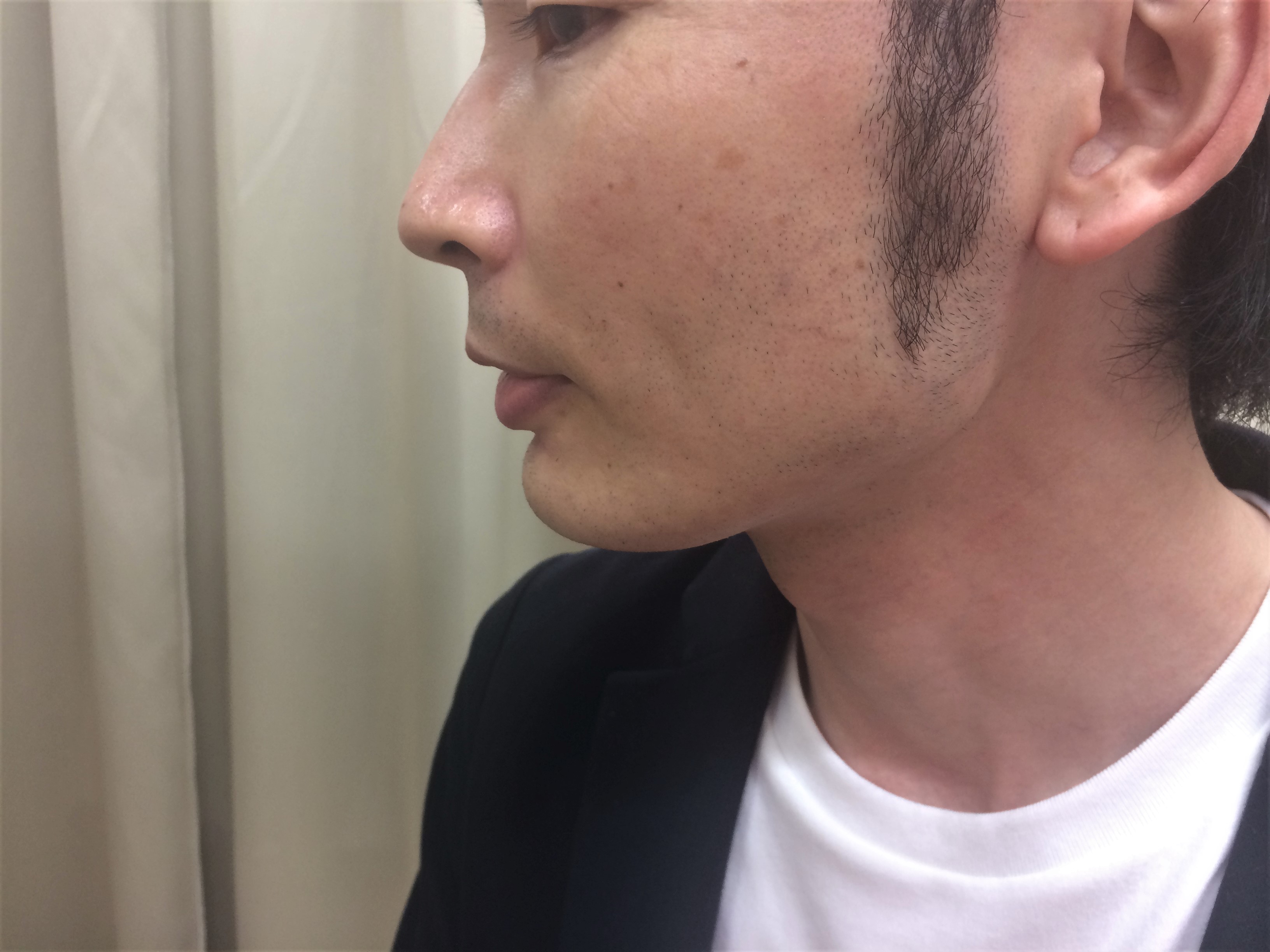 頬ひげ脱毛4回目の施術前
