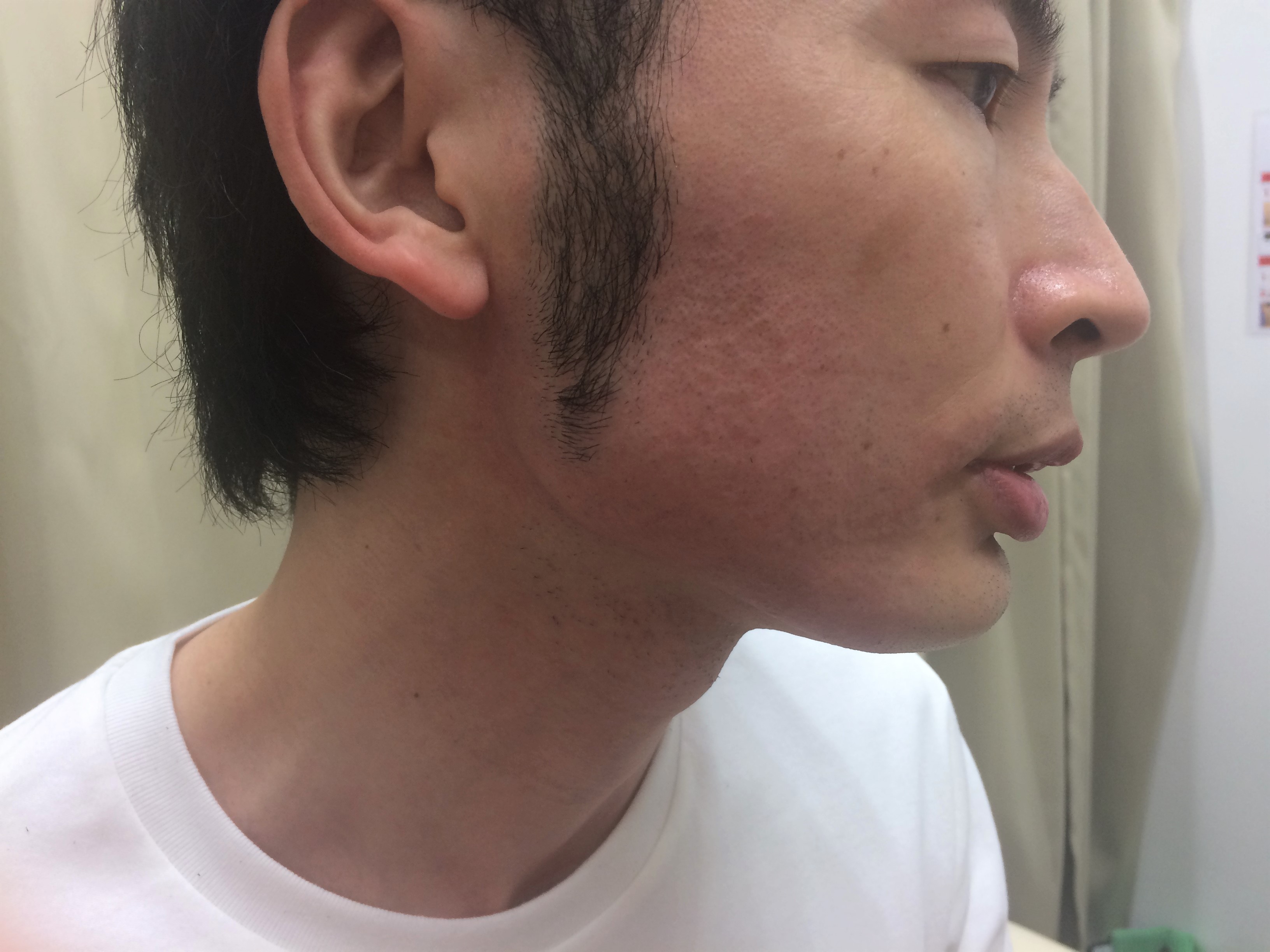 頬ひげ脱毛4回目の施術後