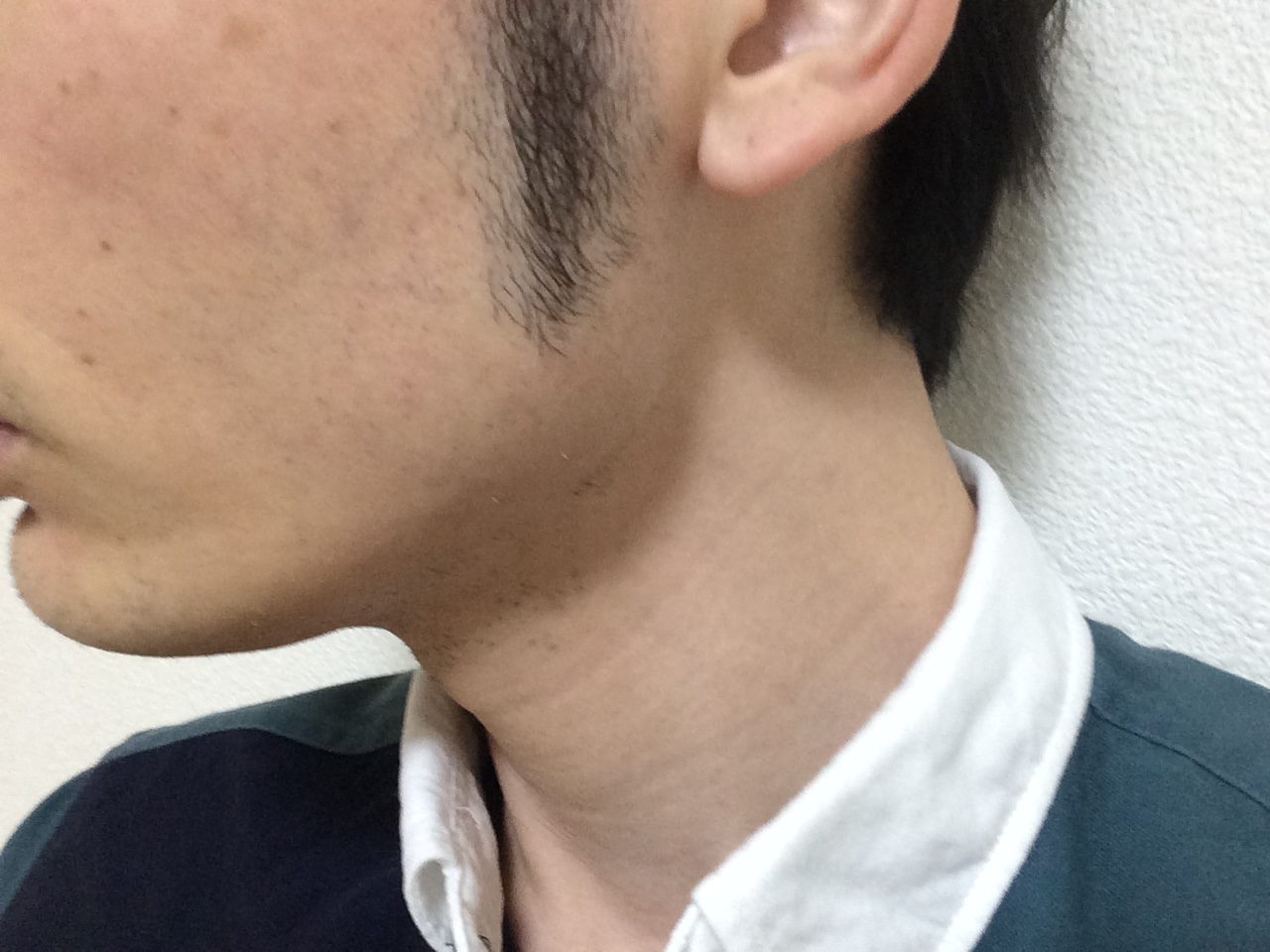 頬ひげ脱毛5回目の効果