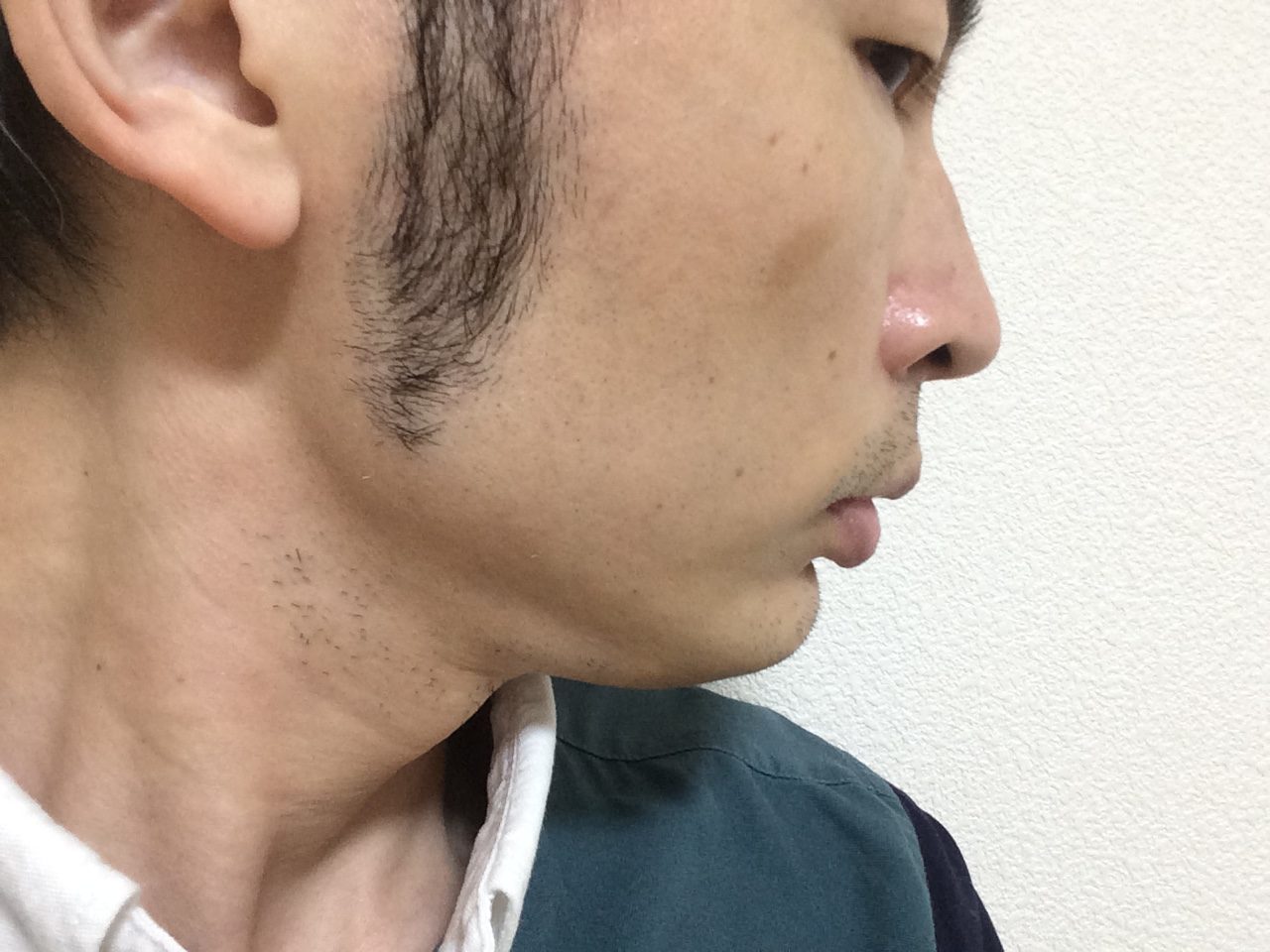 頬ひげ脱毛5回目の効果
