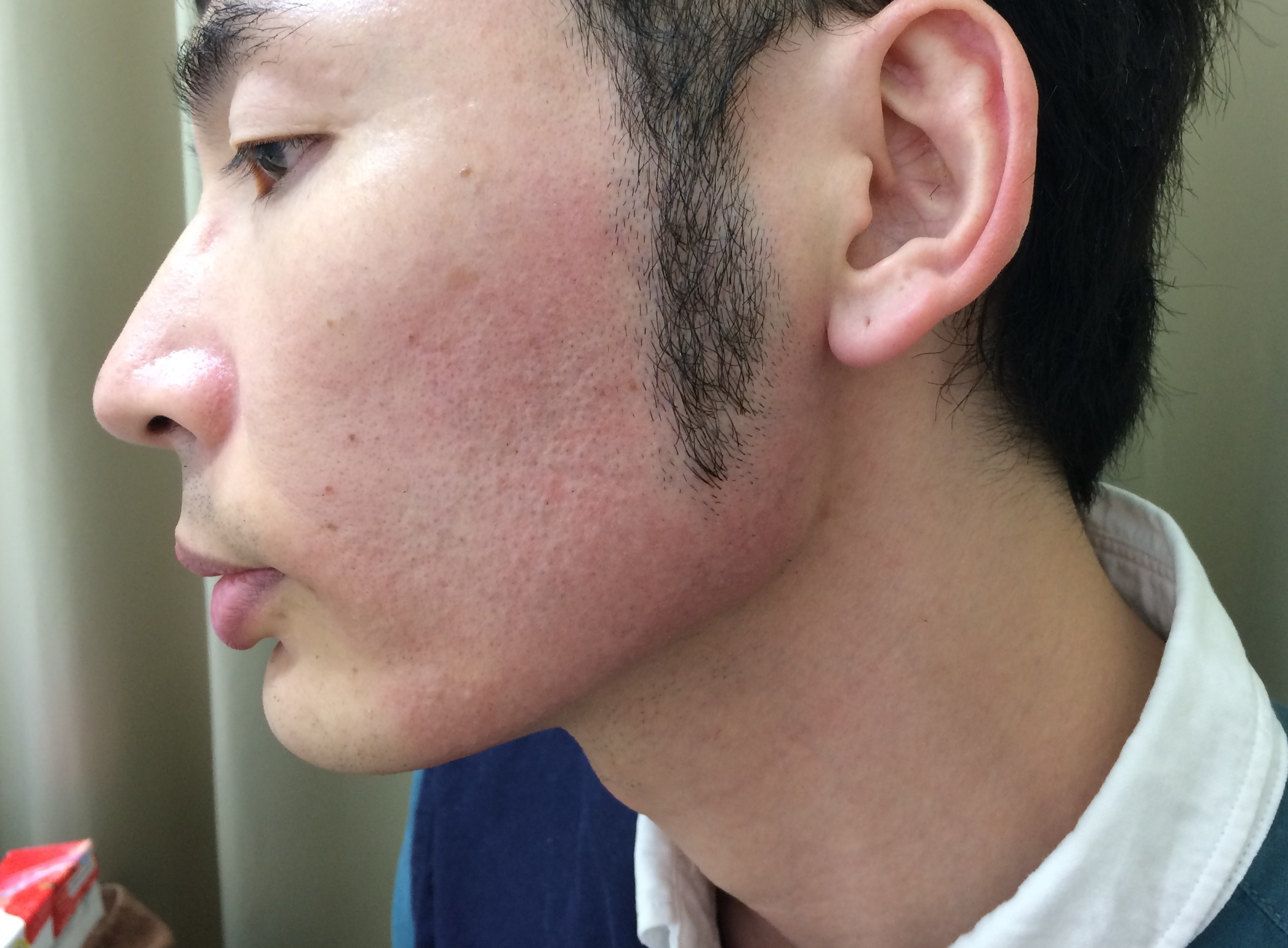 頬ひげ脱毛5回目の施術後