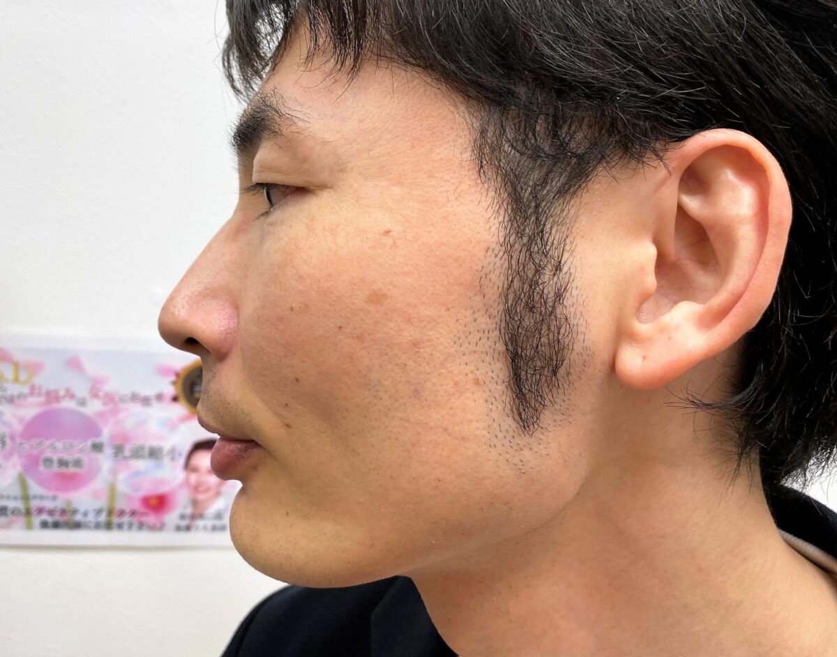 頬ヒゲ脱毛 毛穴は残ったが満足の結果で6回プラン終了 体験談 メンズ脱毛レポート