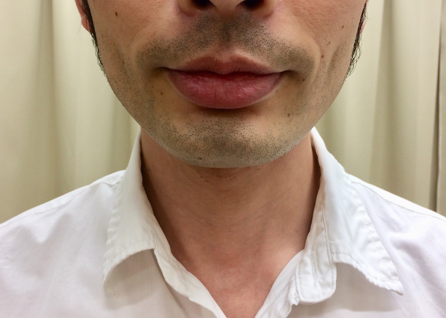 ひげ脱毛1回目直前