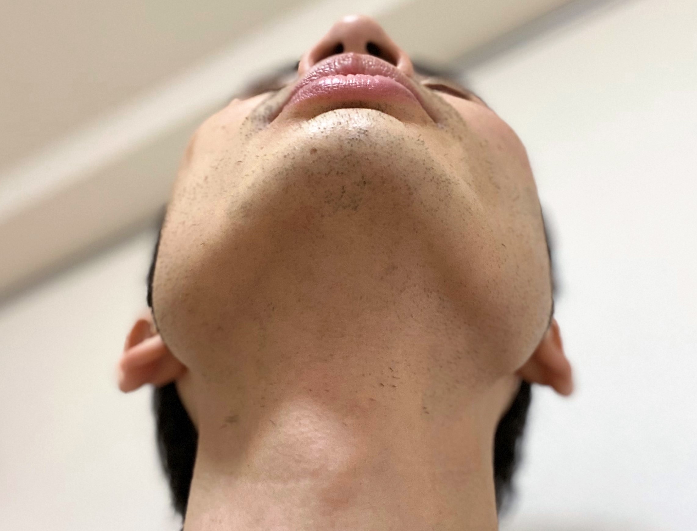 ヒゲ脱毛再生