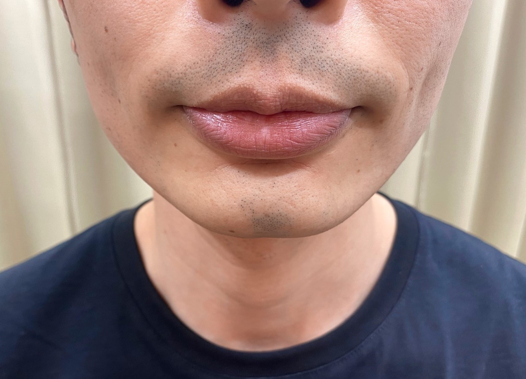 ヒゲ脱毛15回目施術前