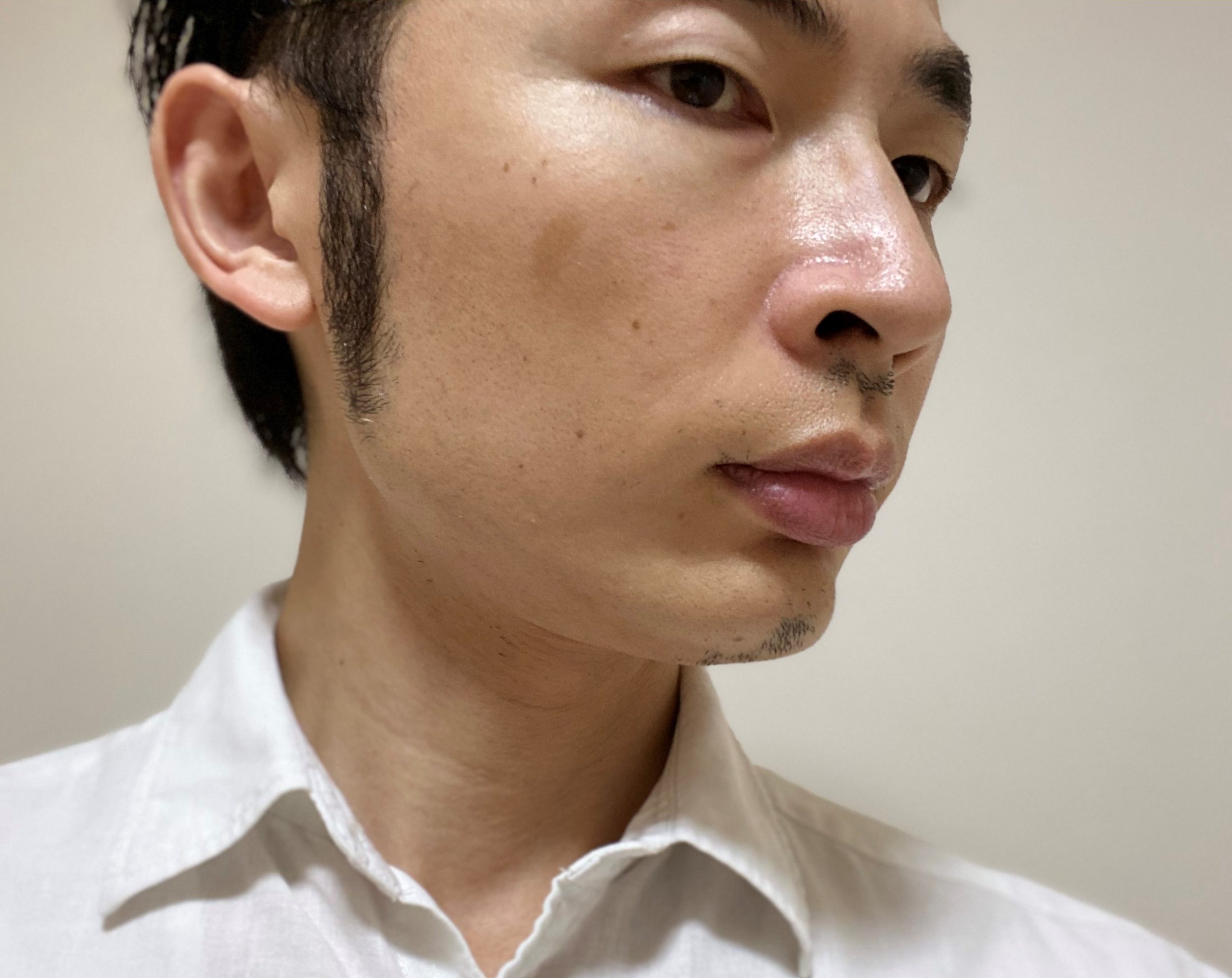 頬ヒゲ脱毛7回目1カ月後右