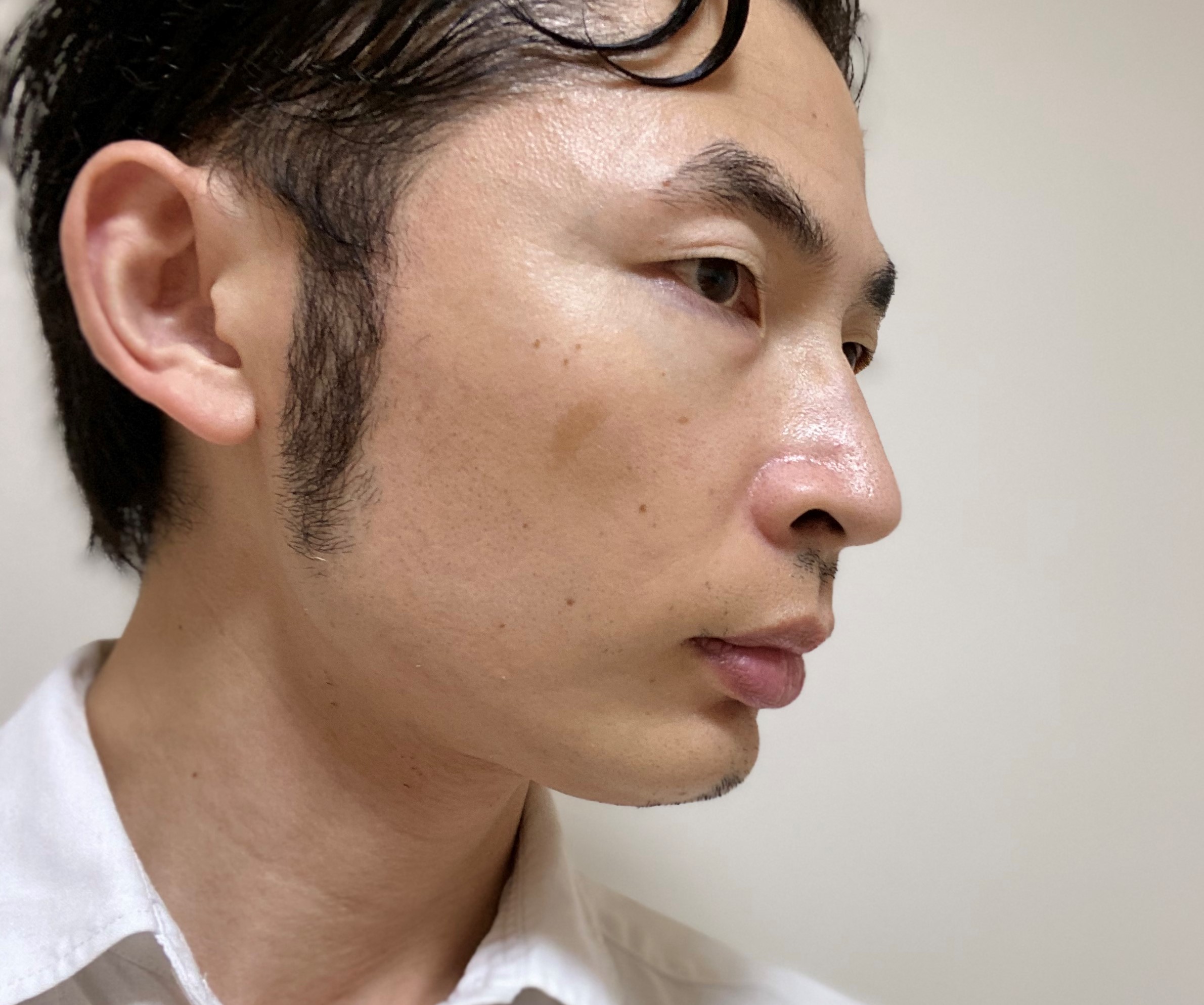 頬ヒゲ脱毛7回目1カ月後左