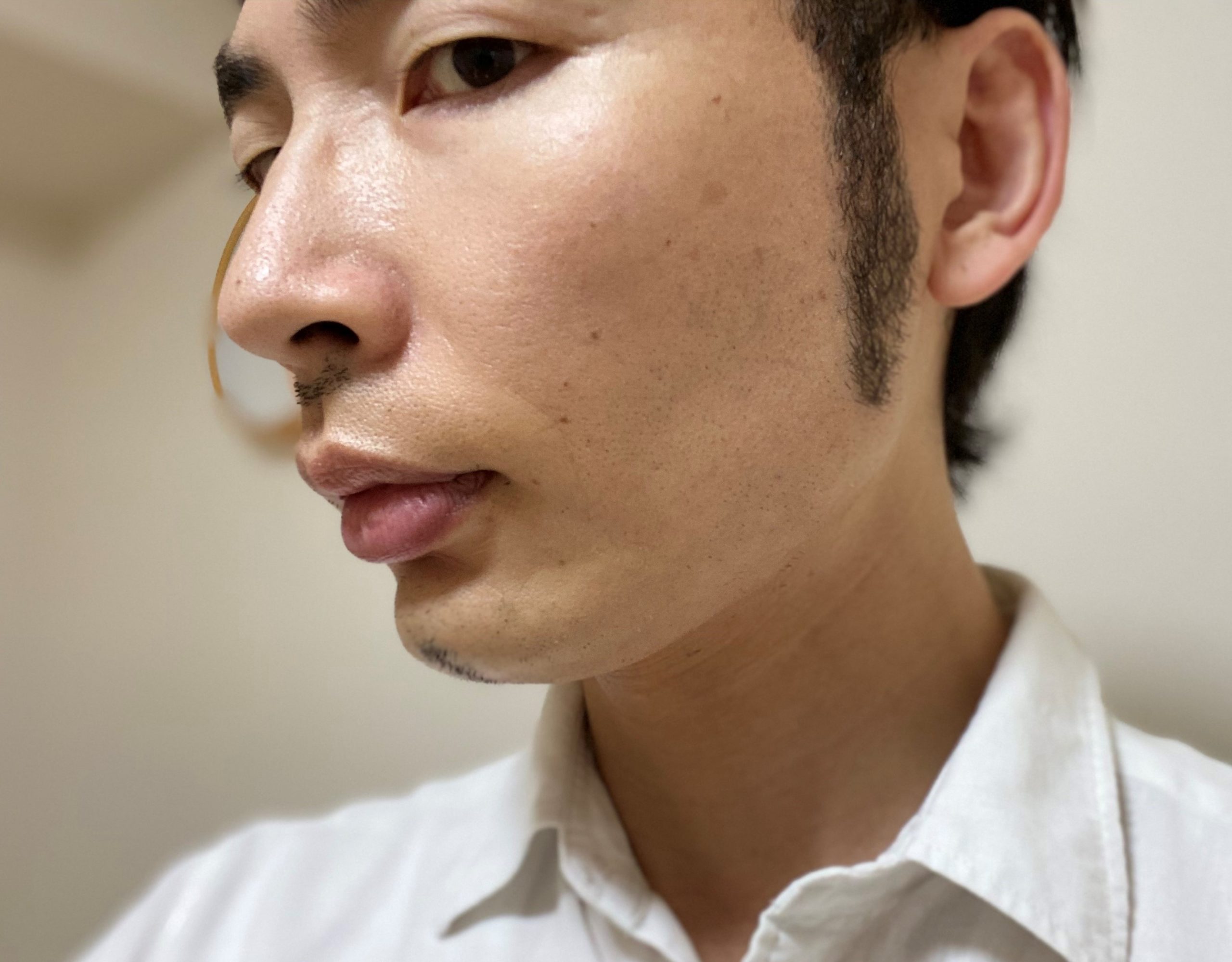 頬ヒゲ脱毛7回目1カ月後左