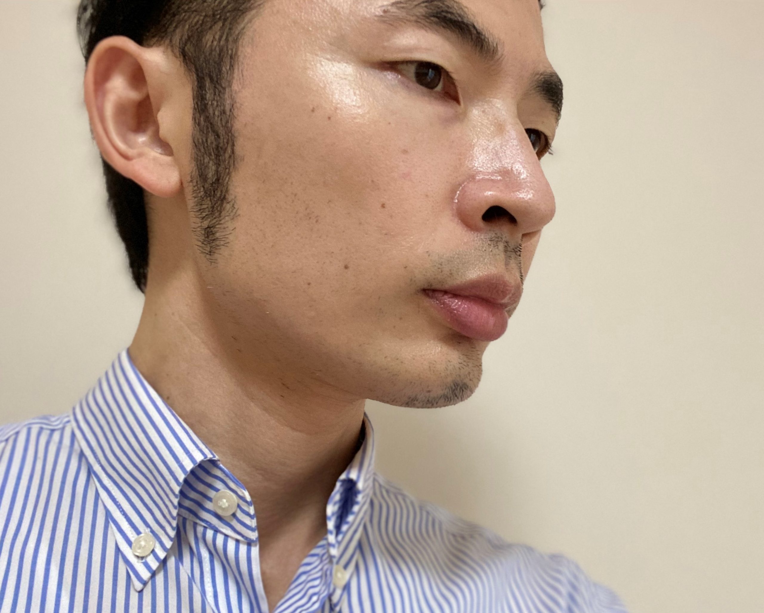頬ヒゲ脱毛7回目2カ月後右