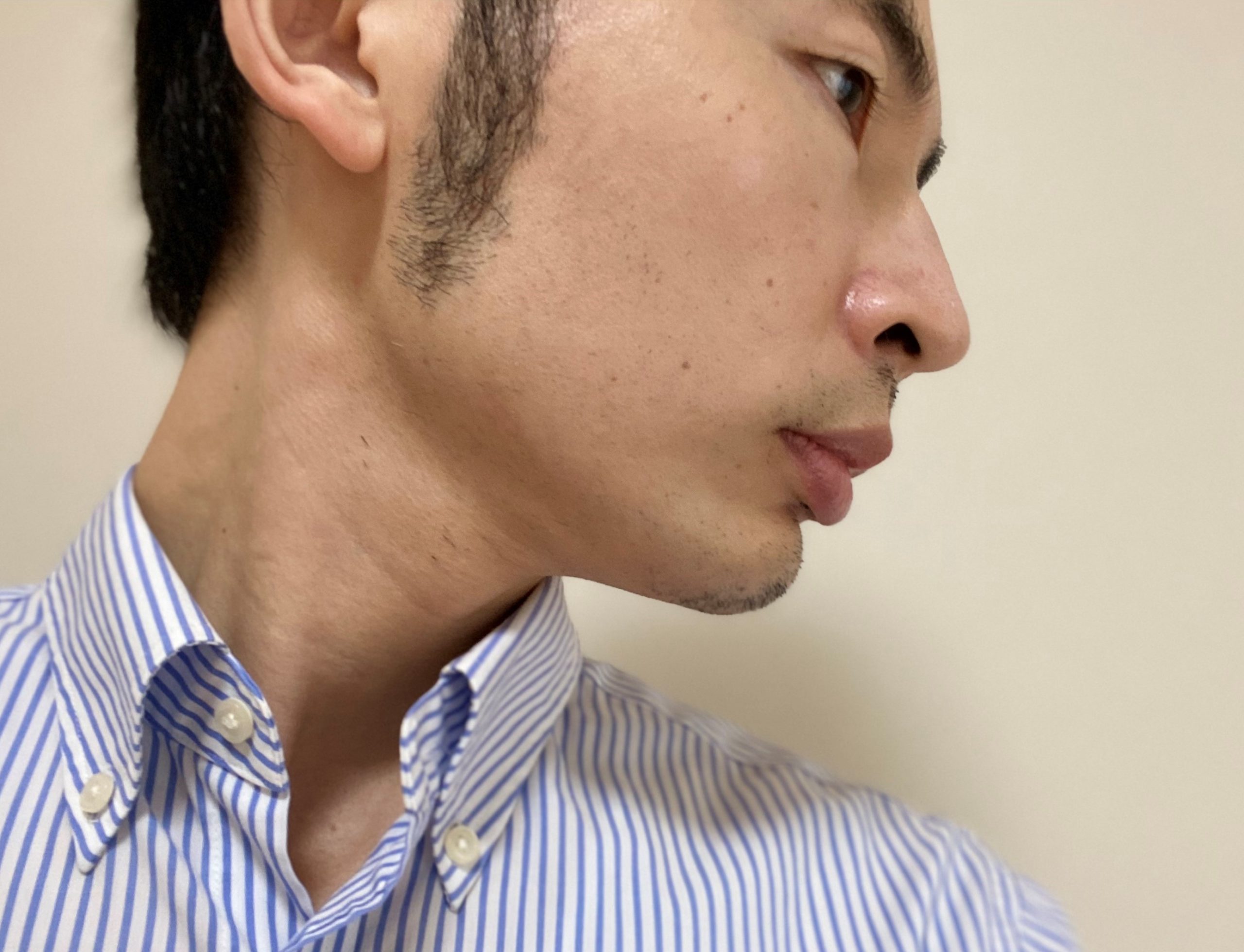頬ヒゲ脱毛7回目2カ月後右