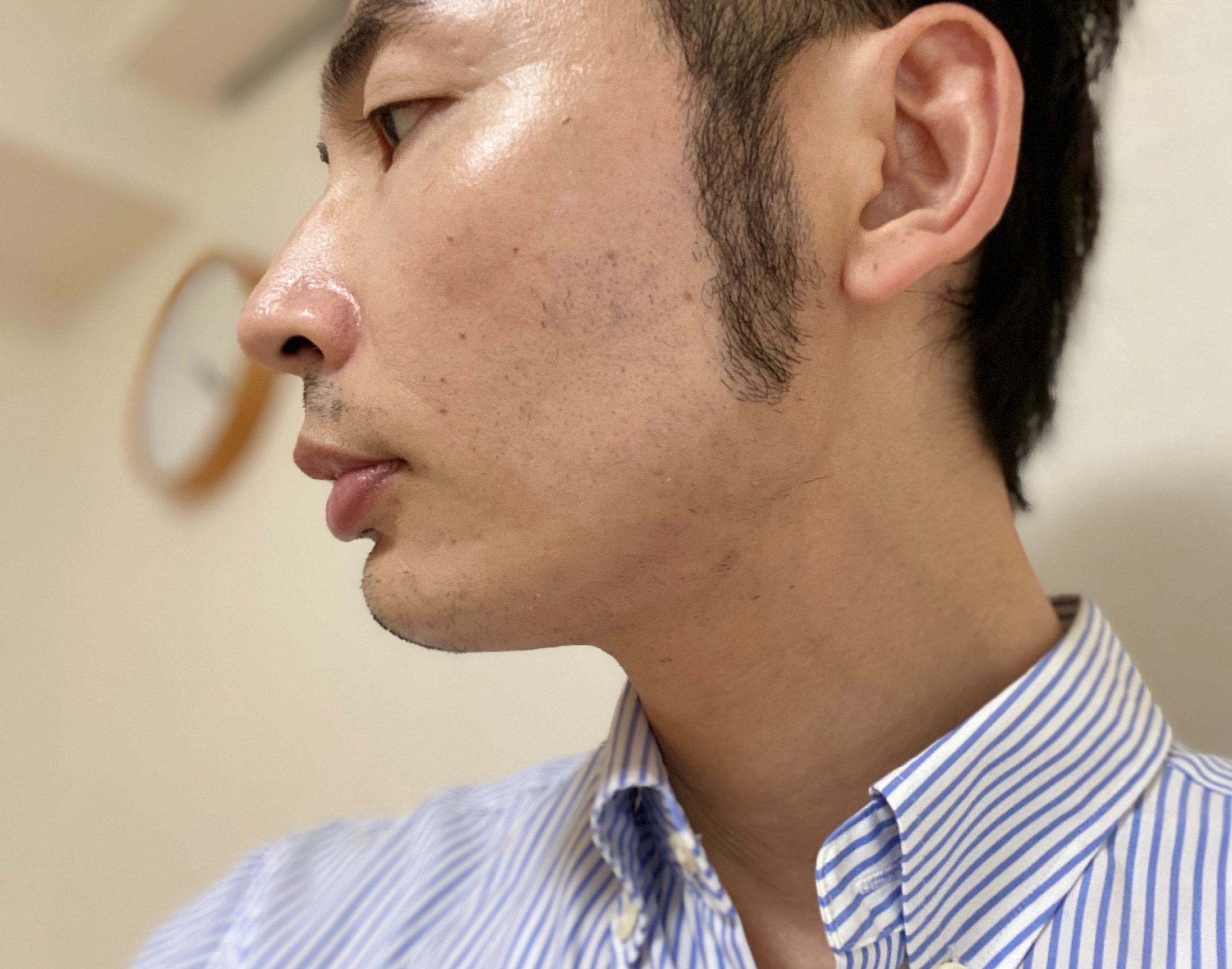 頬ヒゲ脱毛7回目2カ月後左