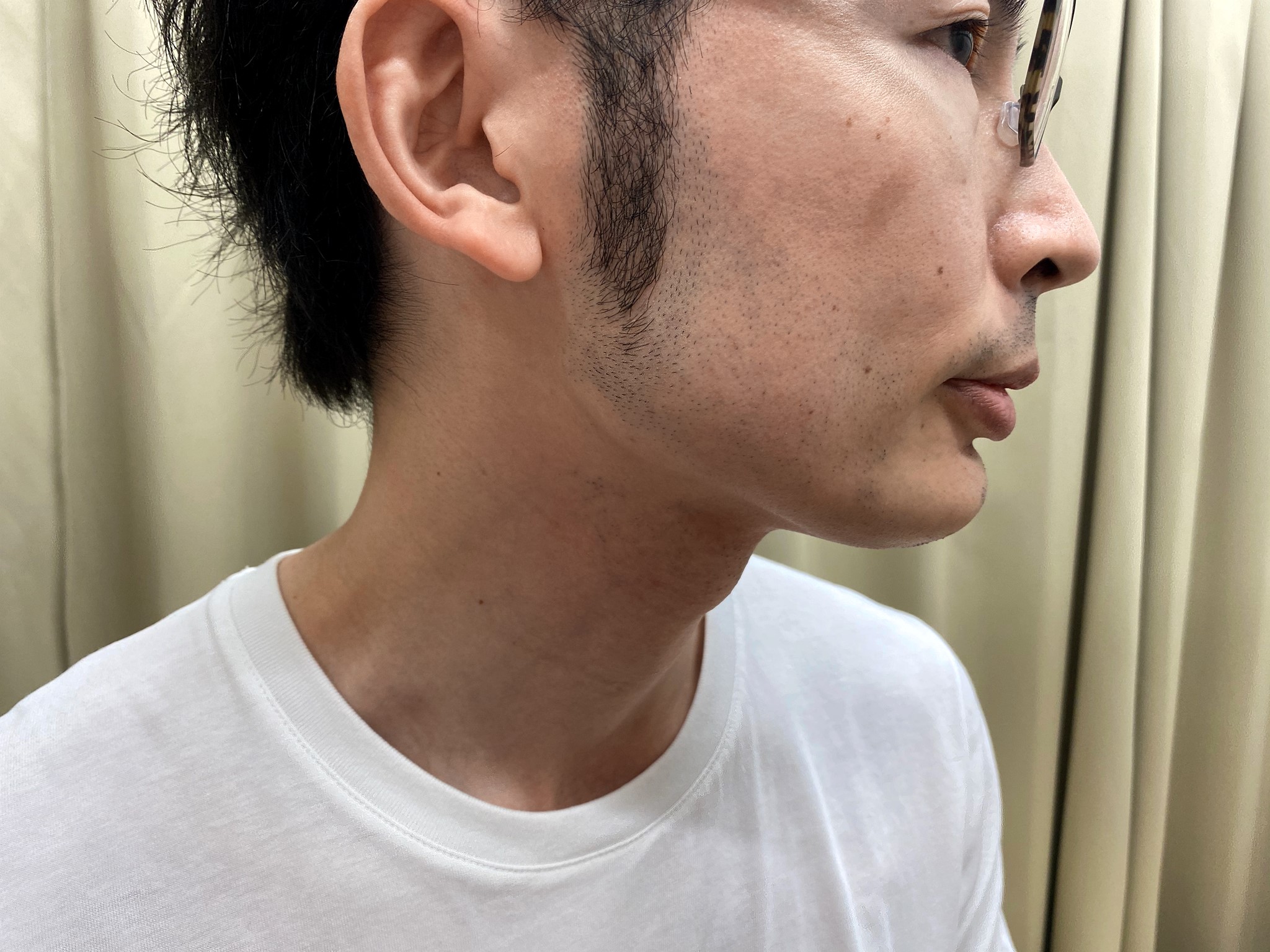 頬ヒゲ脱毛7回目施術前右