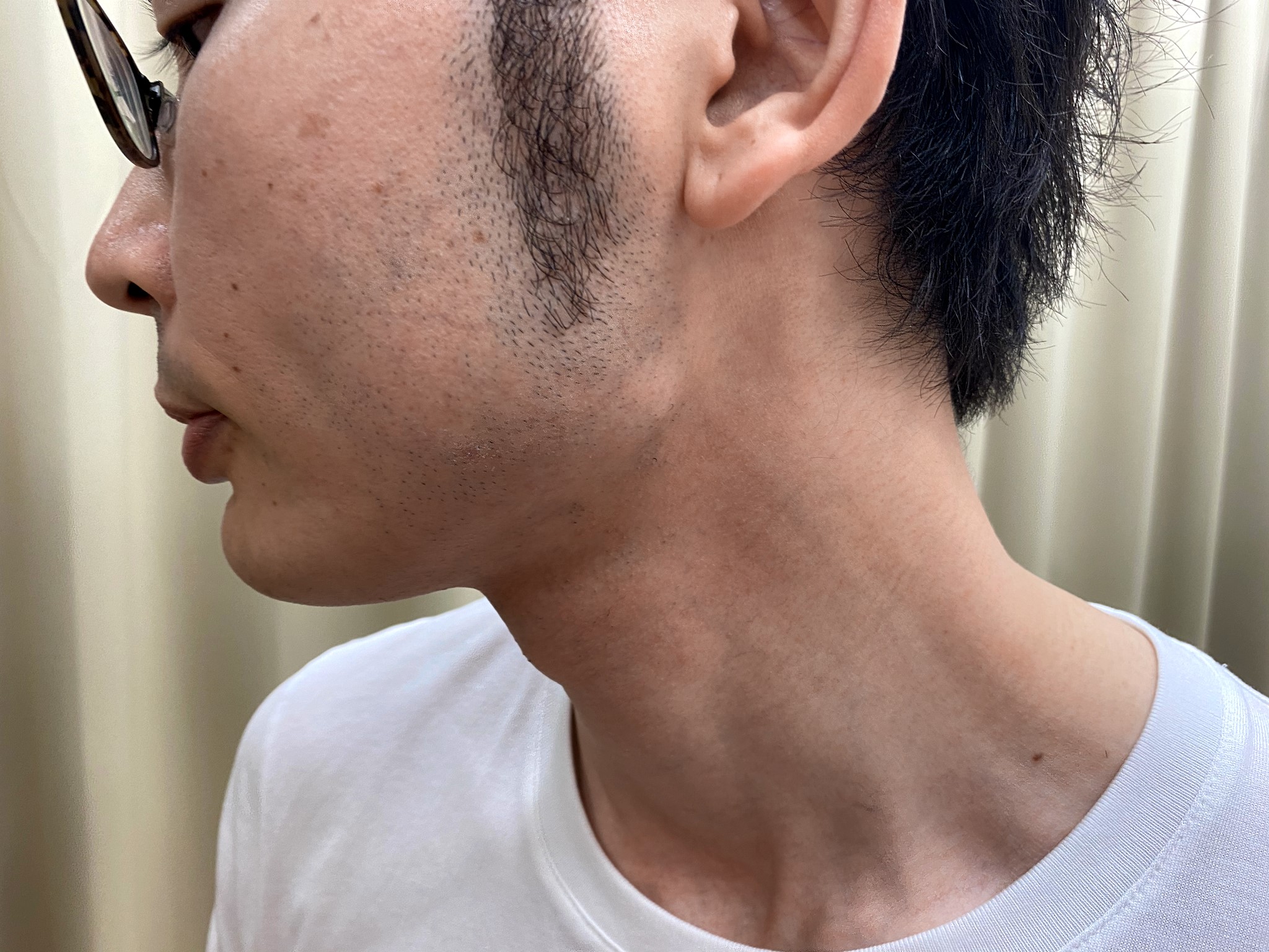 ヒゲ脱毛7回目施術前左