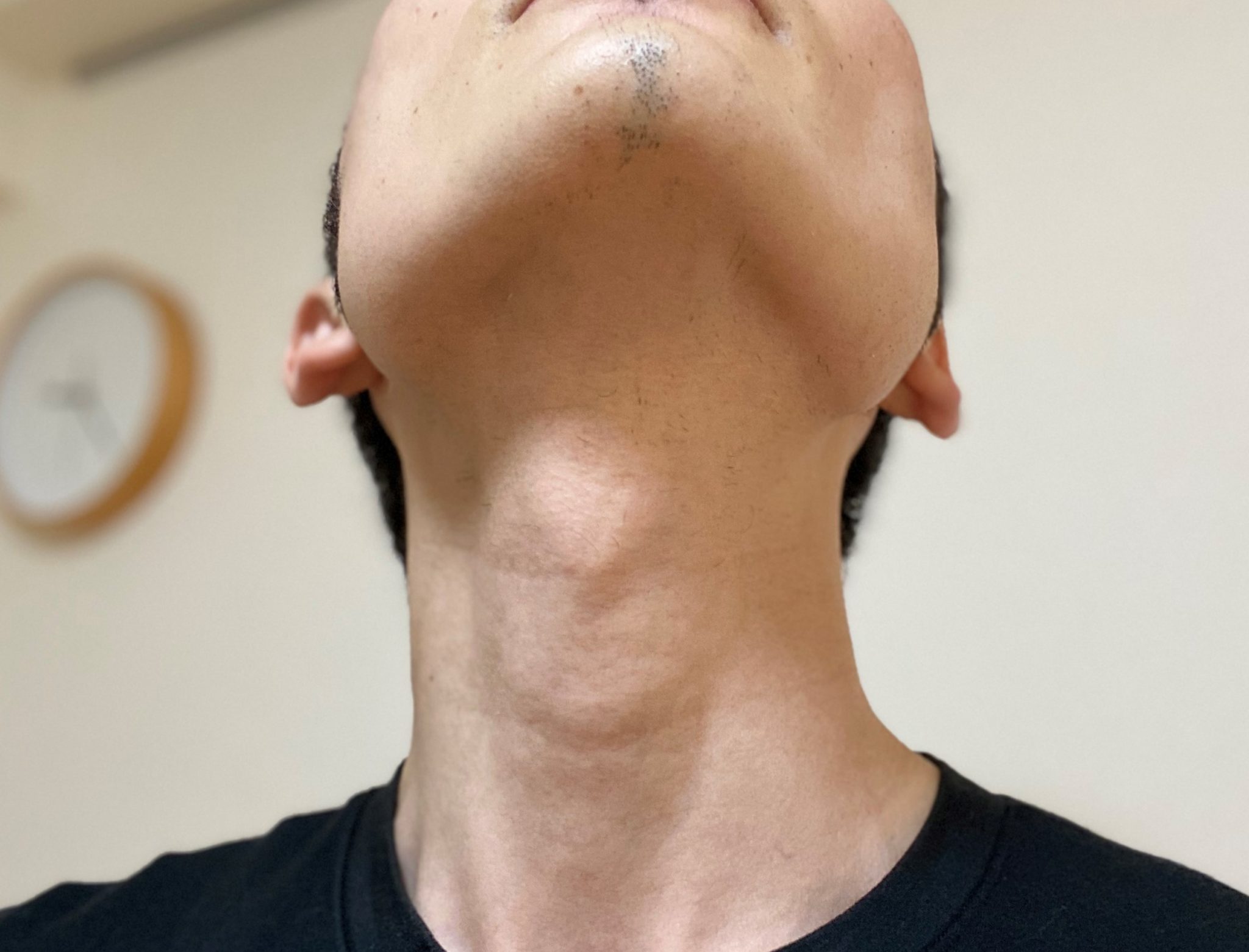 首ヒゲ脱毛3回目 赤みは大で痛みは小 ほぼツルツルに 体験談 メンズ脱毛レポート