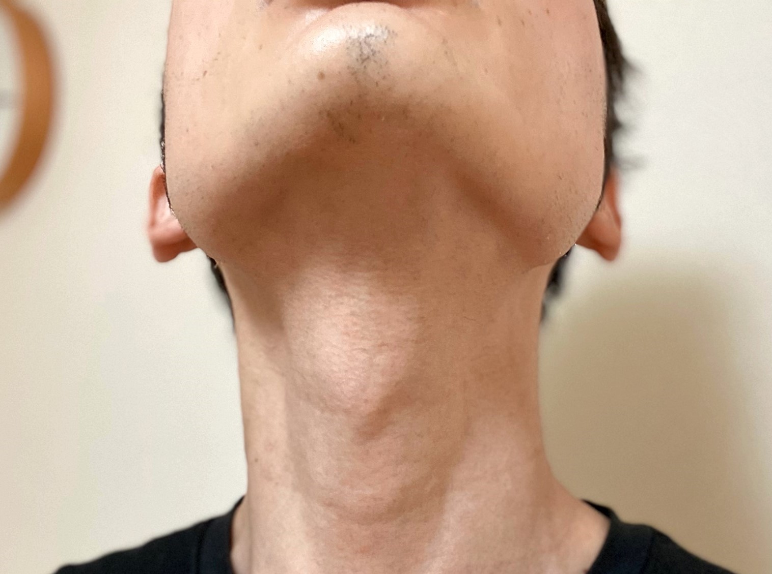 首ヒゲ脱毛 最終4回までの効果を振り返り 画像付きまとめ メンズ脱毛レポート