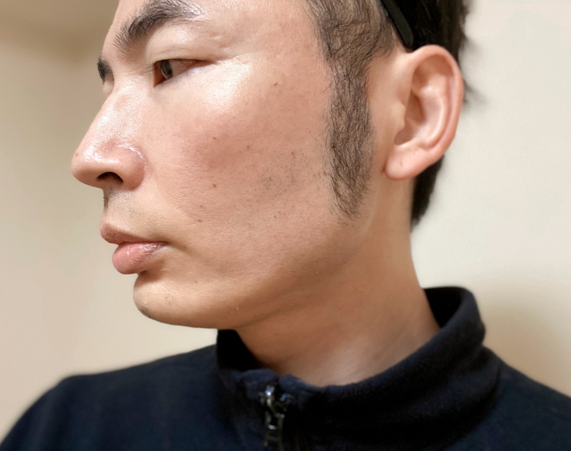 頬ヒゲ脱毛8回目 効果が3カ月後まで続き 生え戻り少 体験談 ヒゲ脱毛レポート