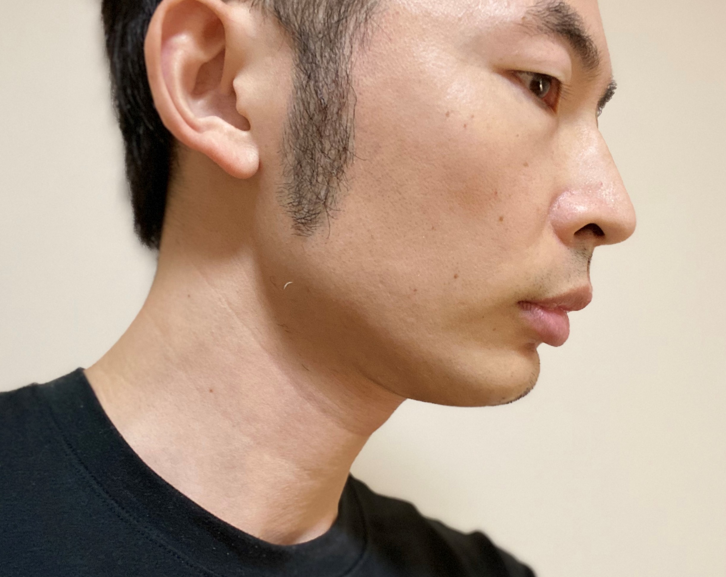 頬ヒゲ脱毛8回目の効果
