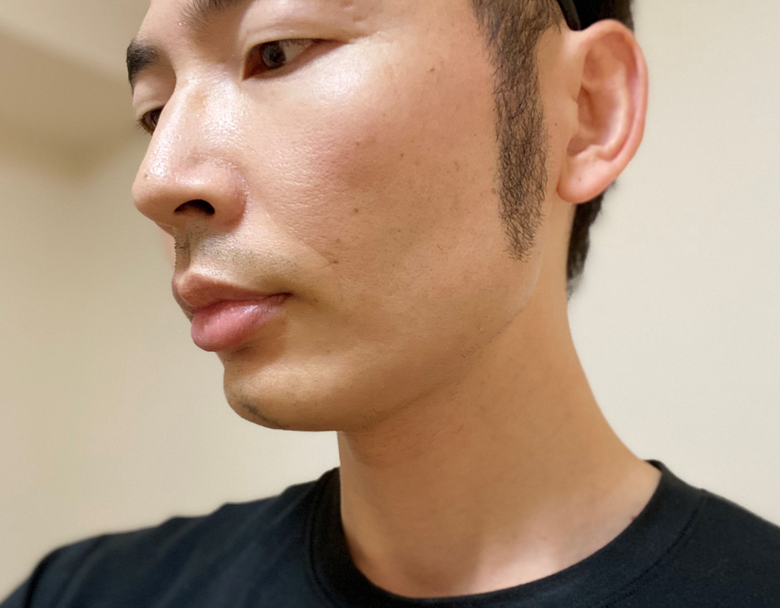 頬ヒゲ脱毛8回目の効果