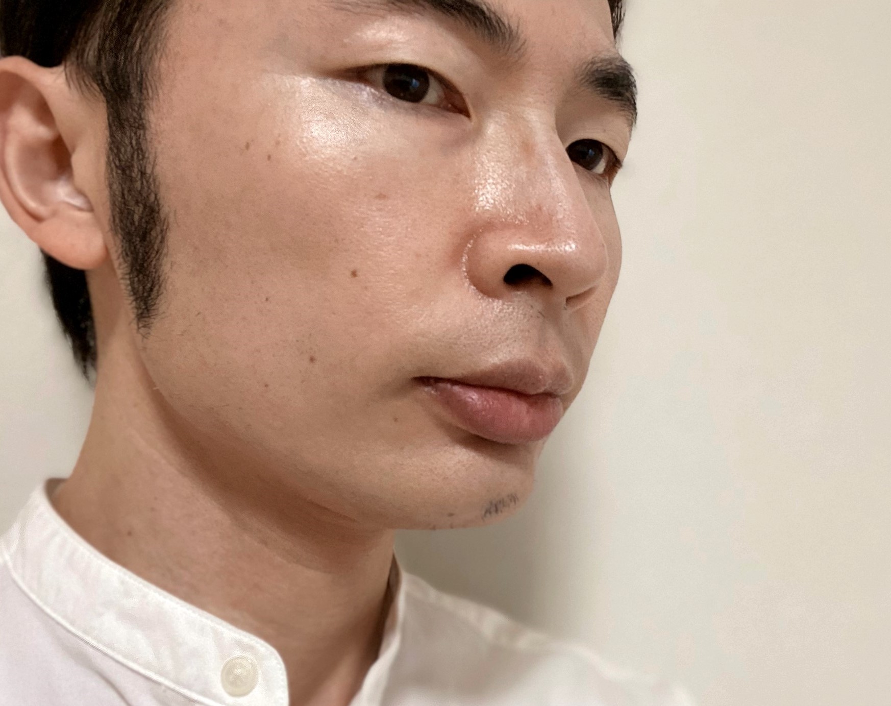 頬ヒゲ脱毛8回目の効果
