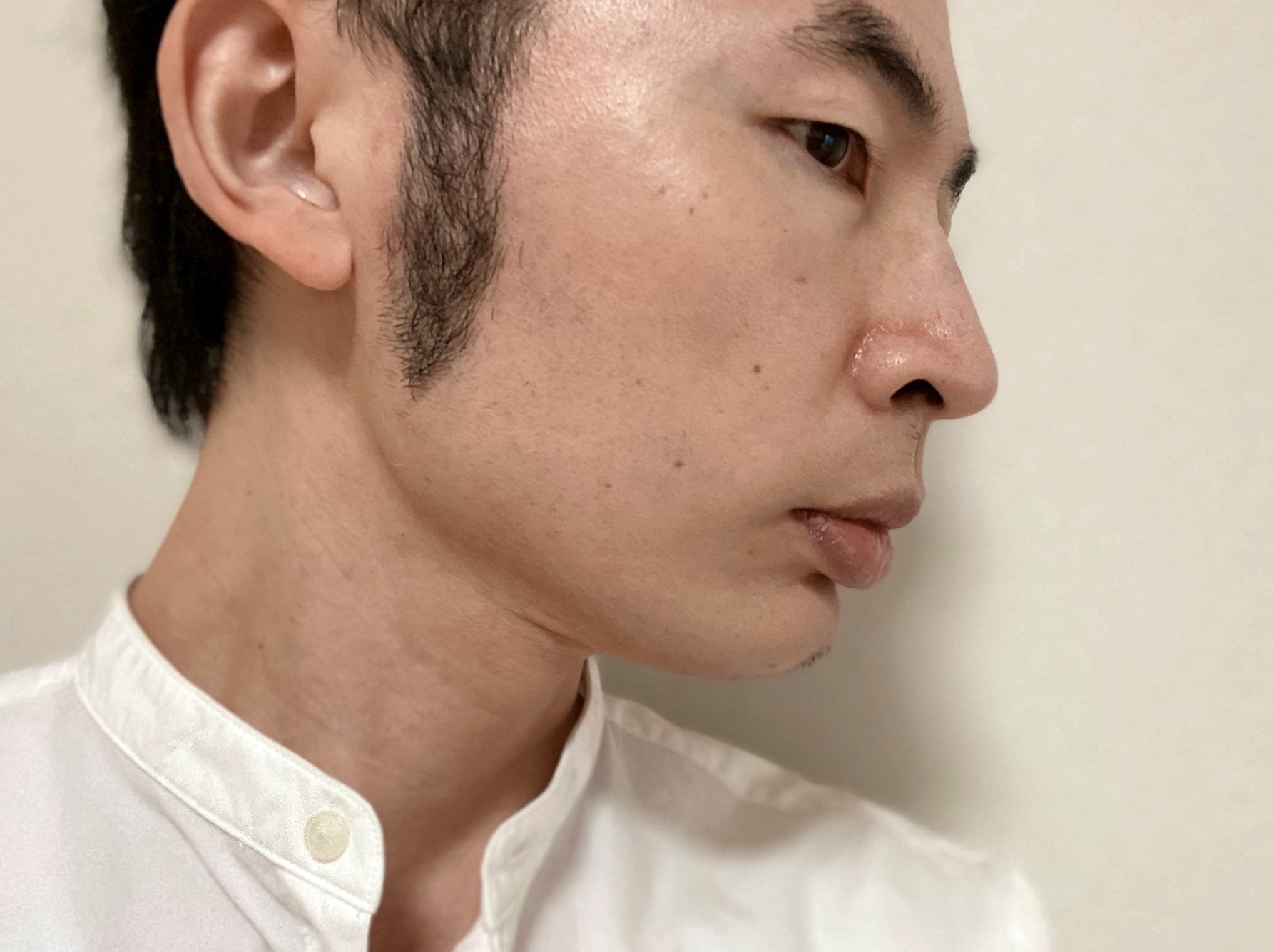 頬ヒゲ脱毛8回目の効果