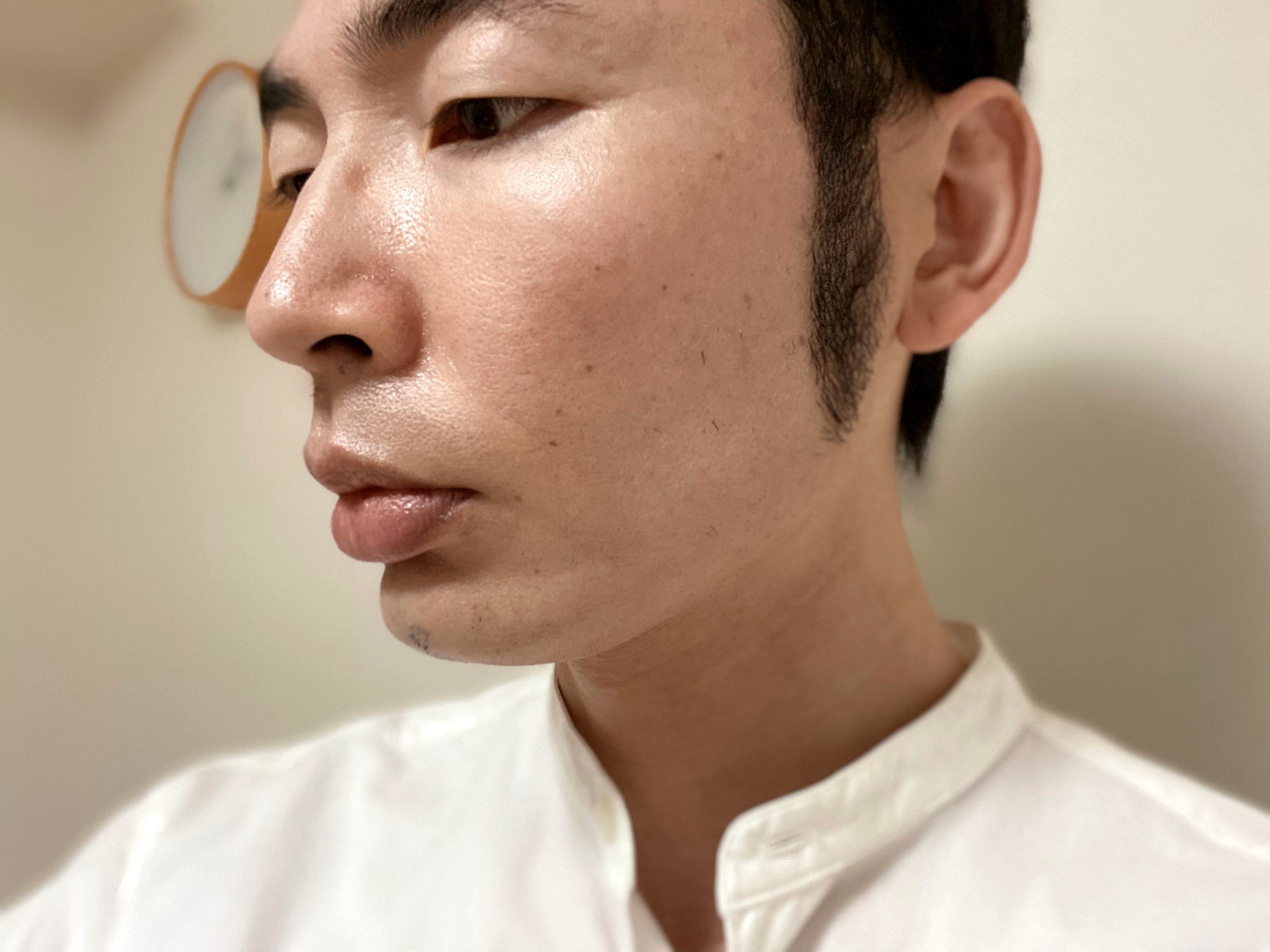 頬ヒゲ脱毛8回目の効果