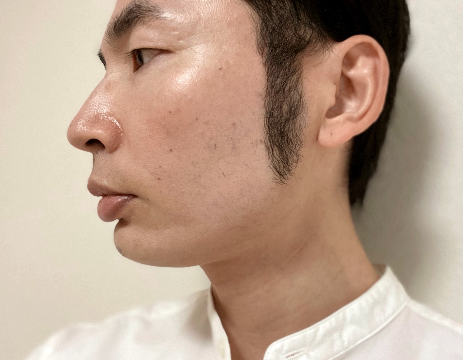 頬ヒゲ脱毛8回目の効果