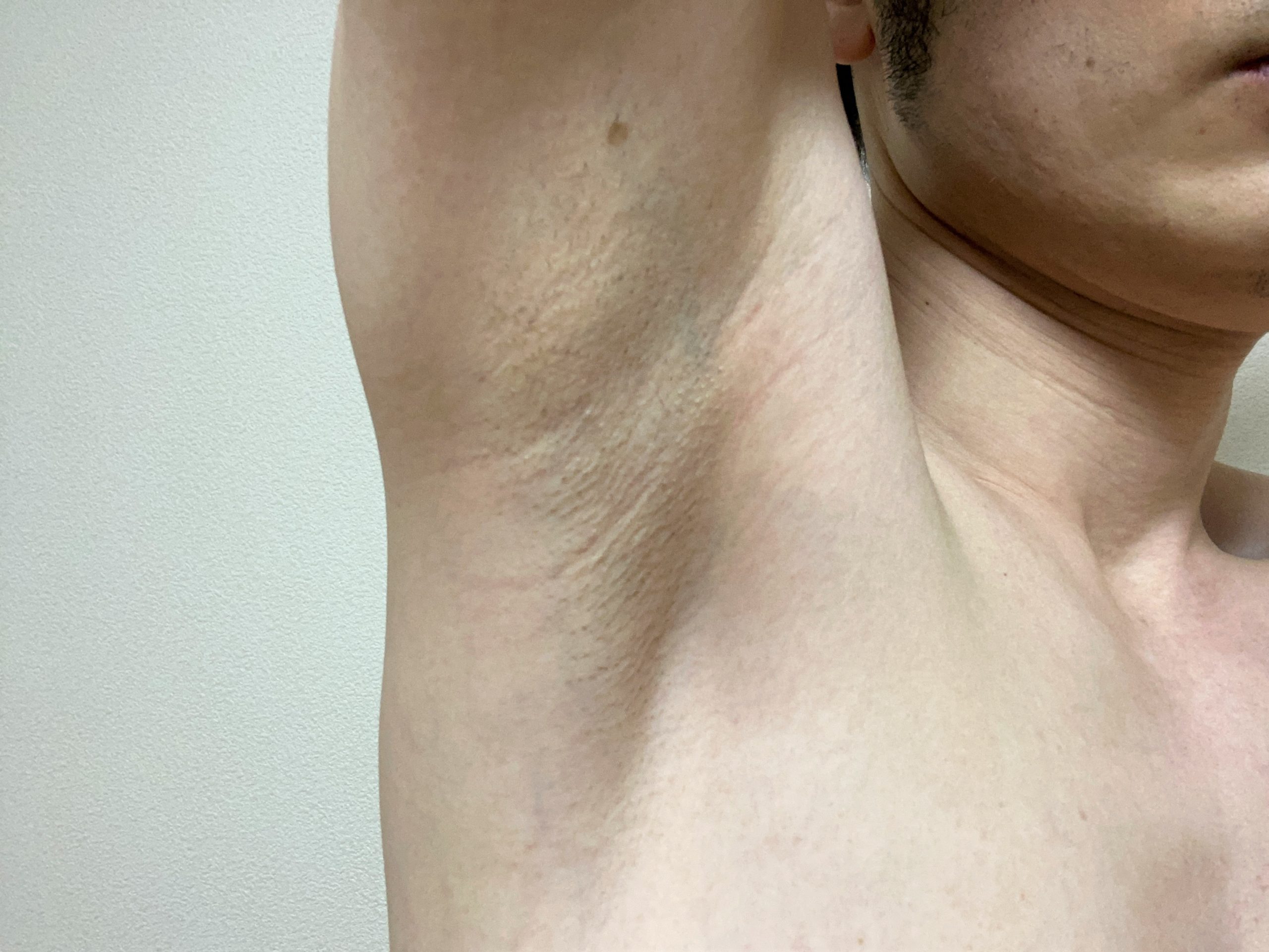 男のわき毛脱毛1回目の効果
