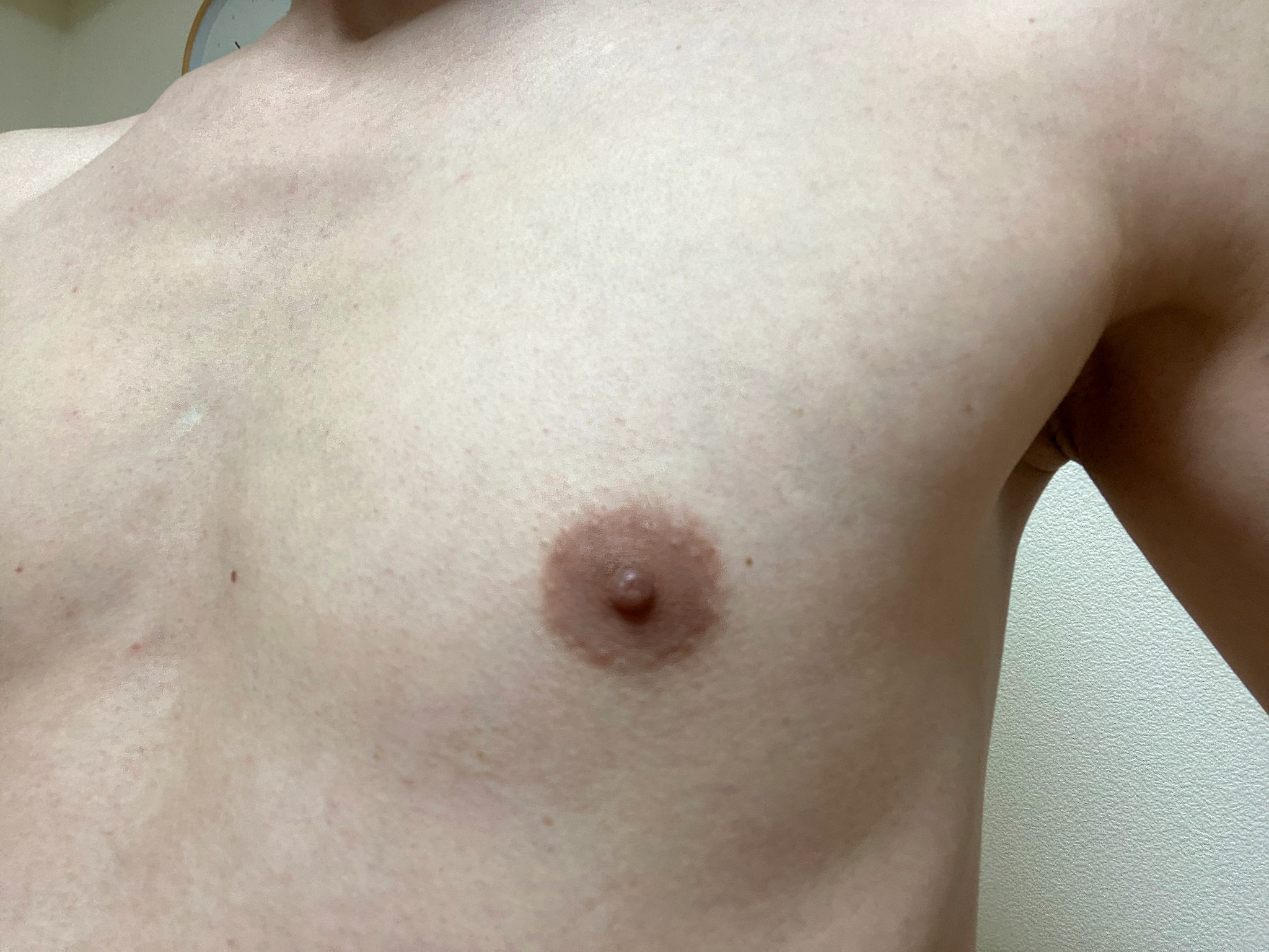男の胸毛脱毛1回目の効果