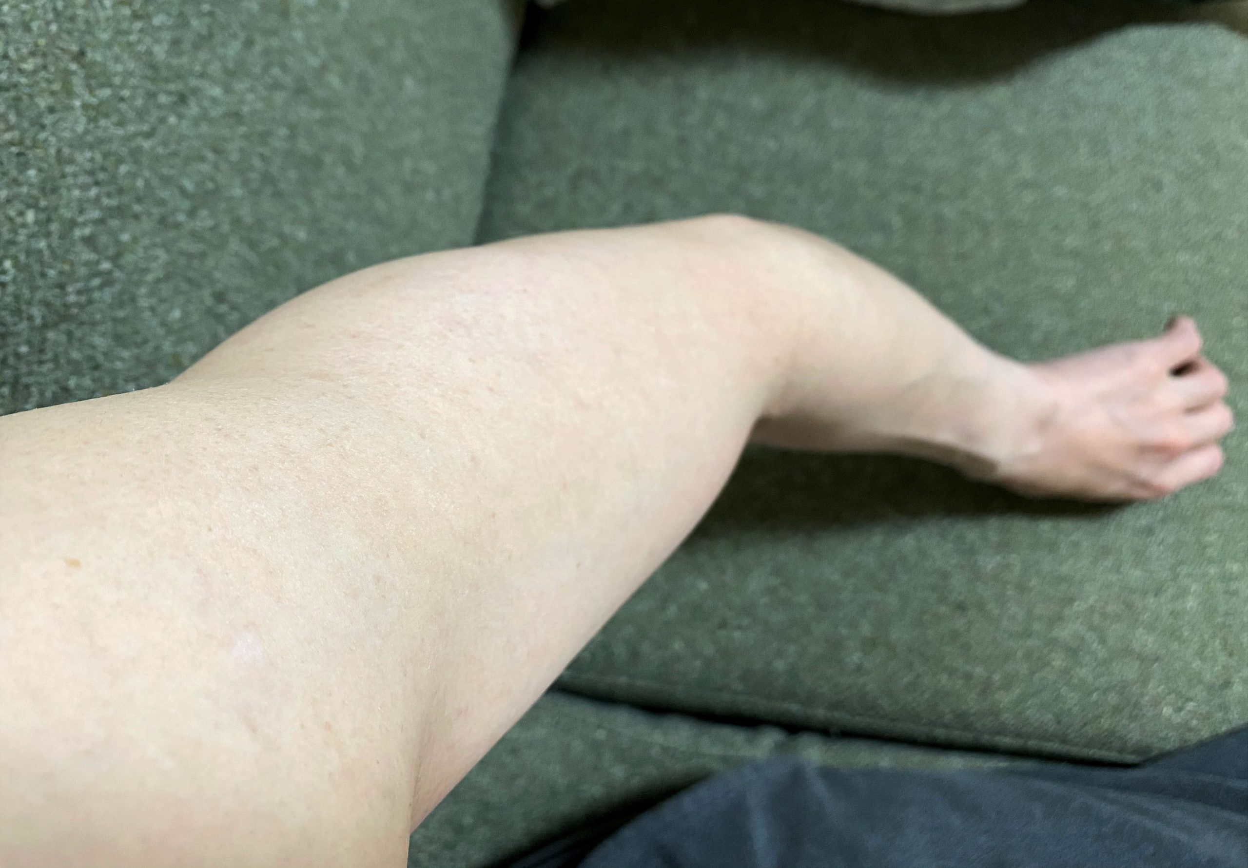 男の腕脱毛1回目の効果