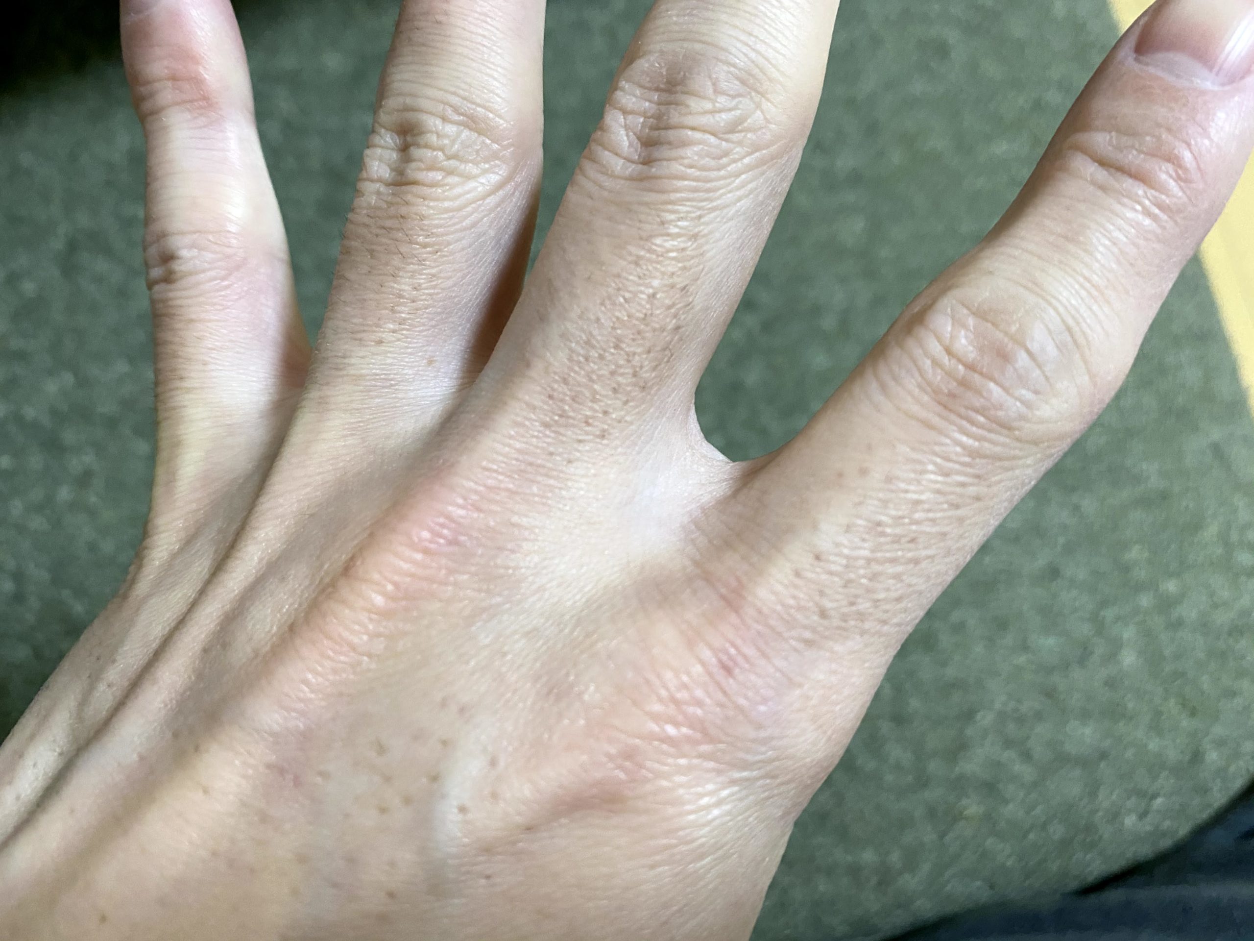 男の腕脱毛1回目の効果