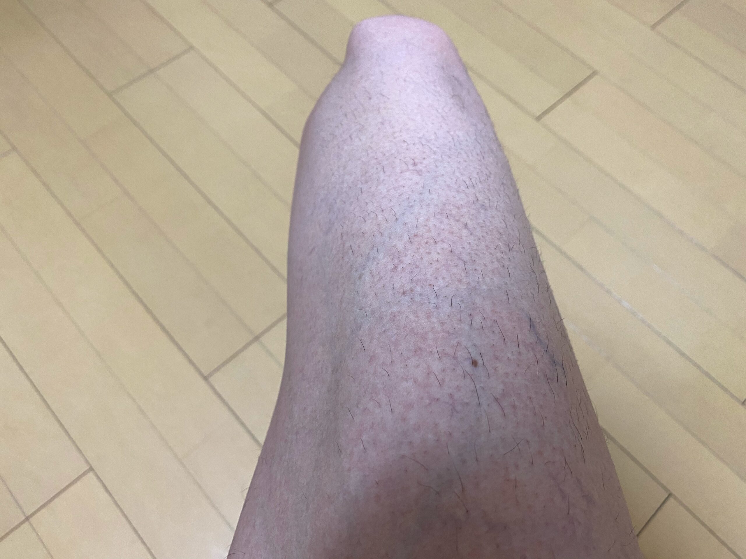 男の全身脱毛1回目2カ月後の脚