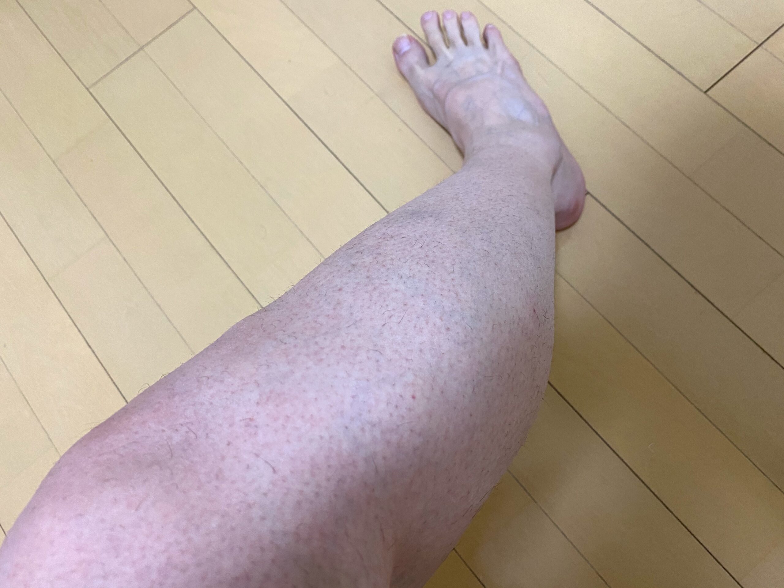 男の全身脱毛1回目2カ月後の脚