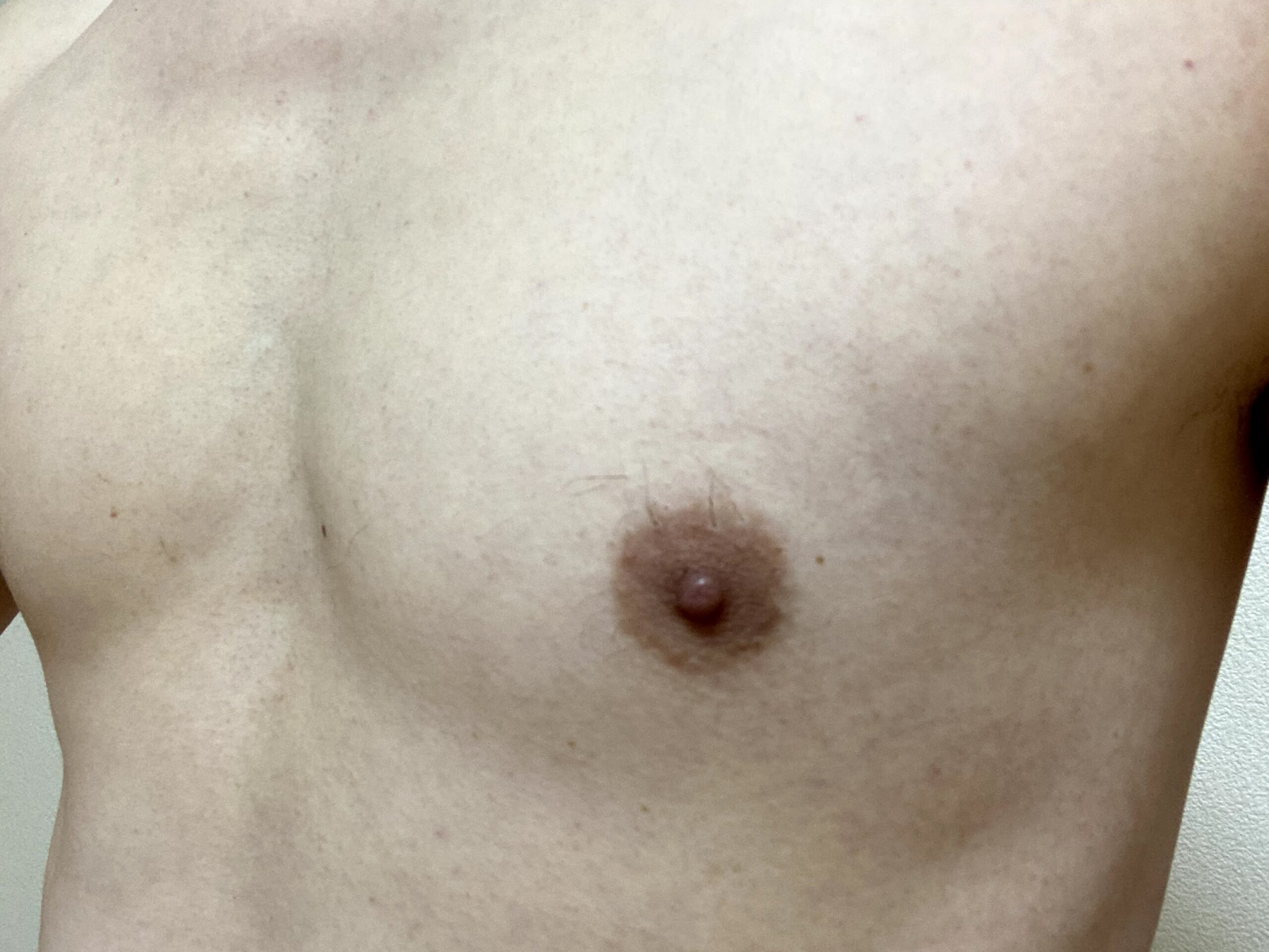 男の全身脱毛1回目2カ月後の胸