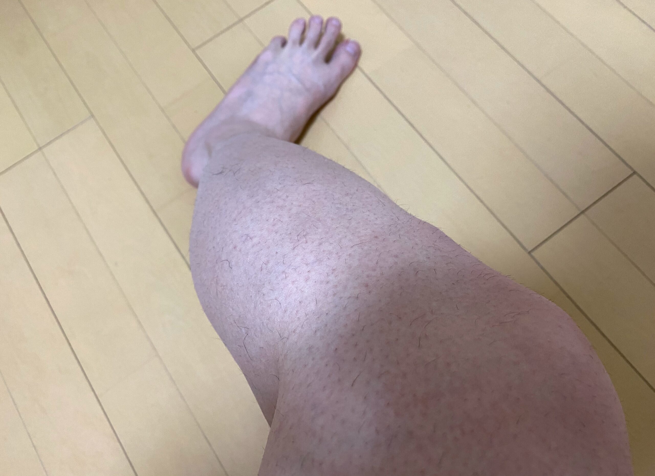 男の全身脱毛1回目2カ月後の脚