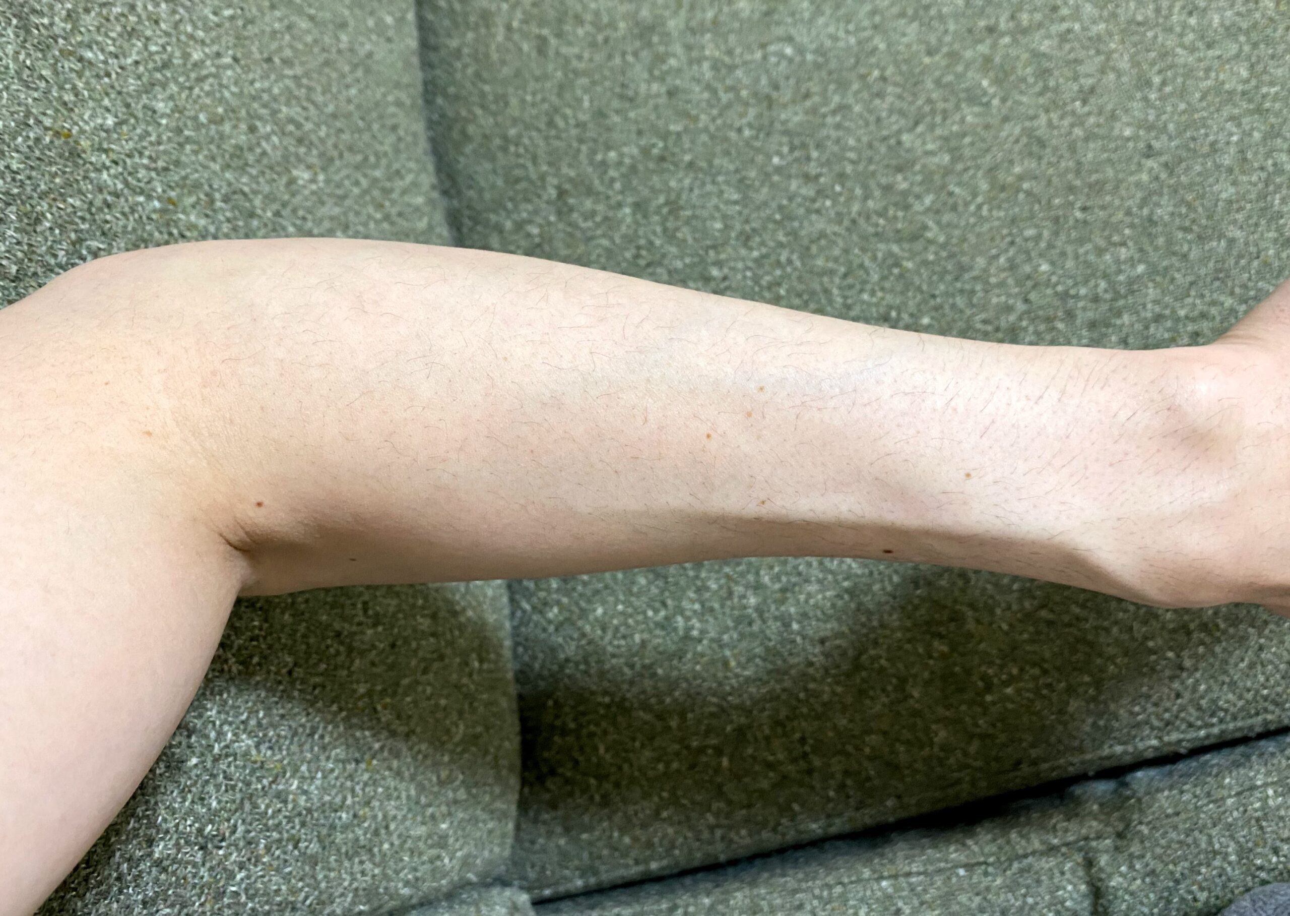 男の全身脱毛1回目2カ月後の腕