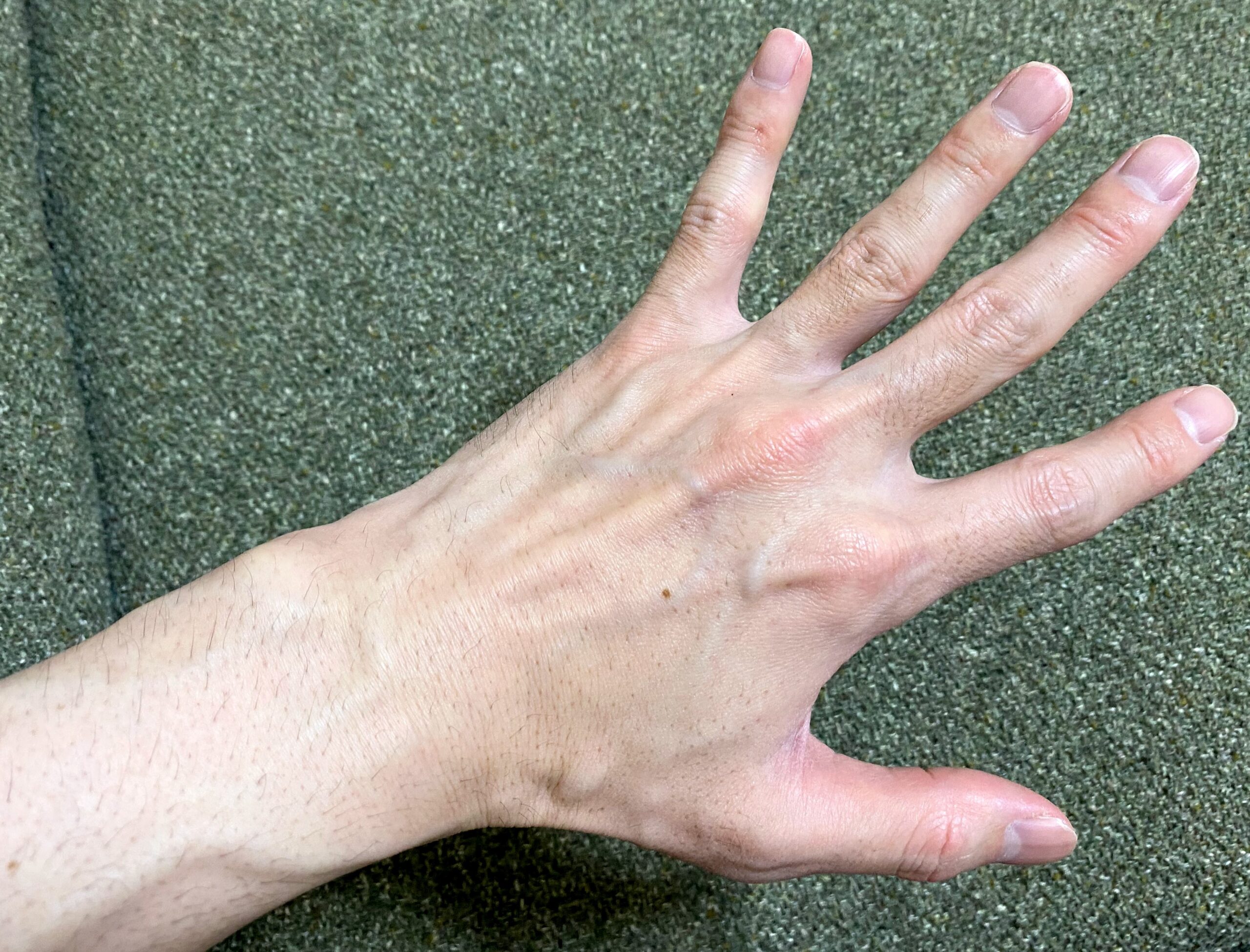 男の全身脱毛1回目2カ月後の腕