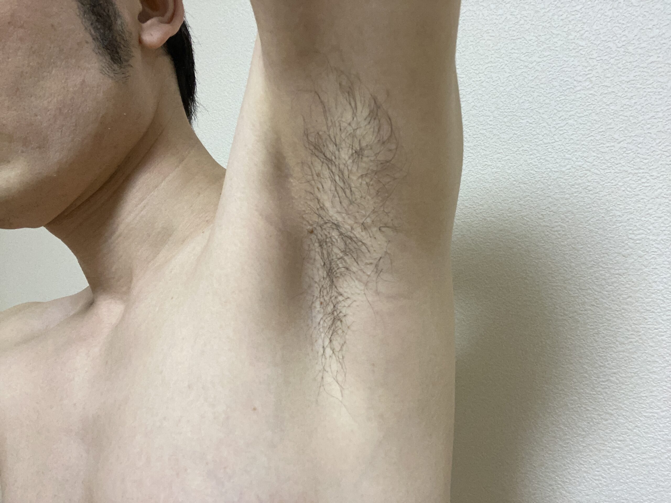 男の全身脱毛1回目の効果