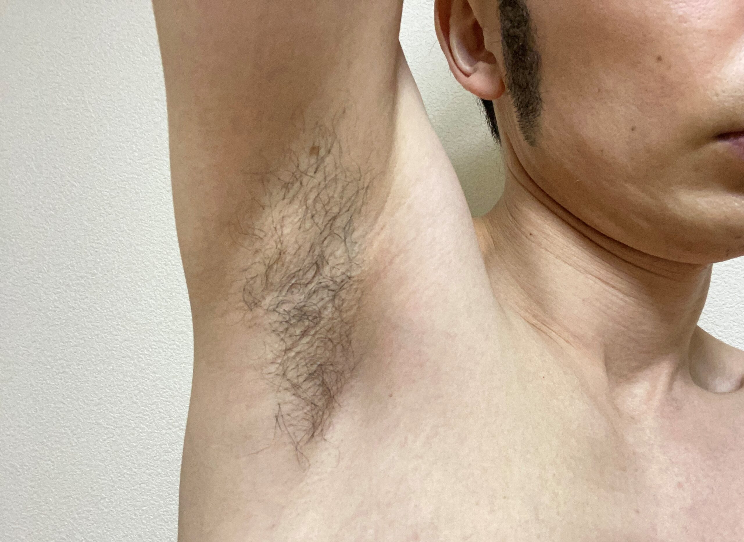 男の全身脱毛1回目の効果