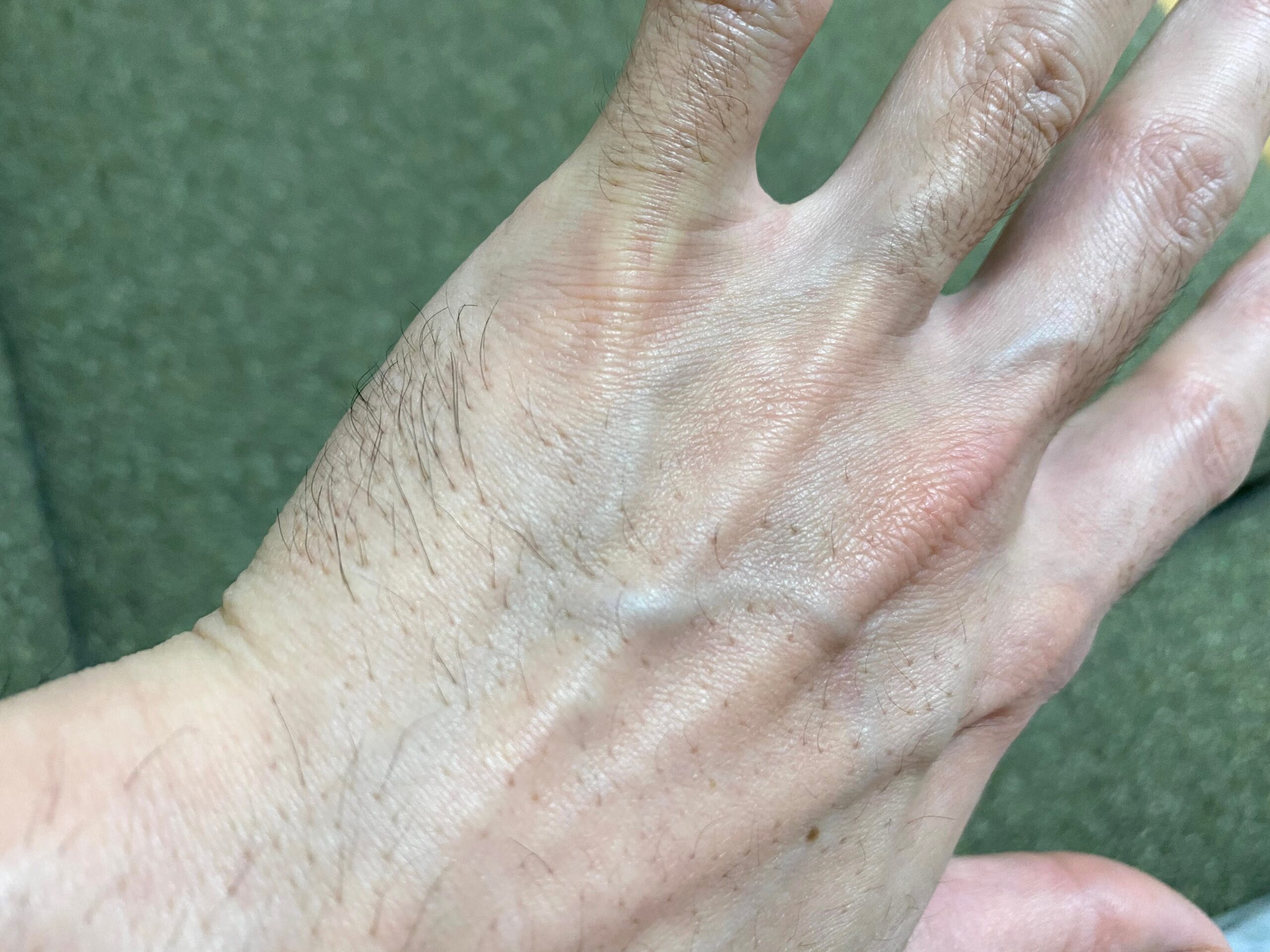 男の全身脱毛1回目の効果