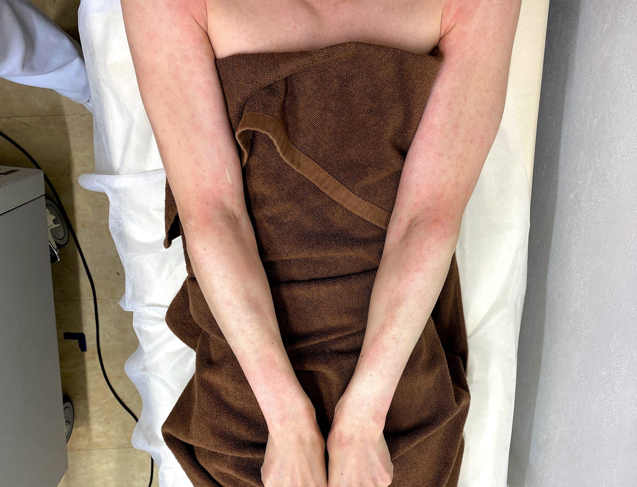 男の腕脱毛1回目の模様