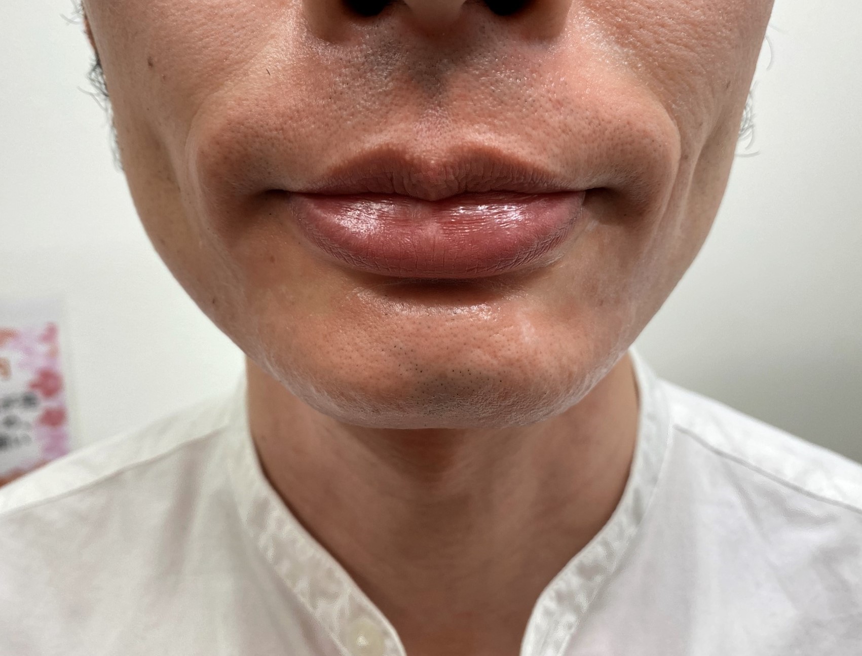 湘南美容クリニックでのヒゲ脱毛18回目の施術後