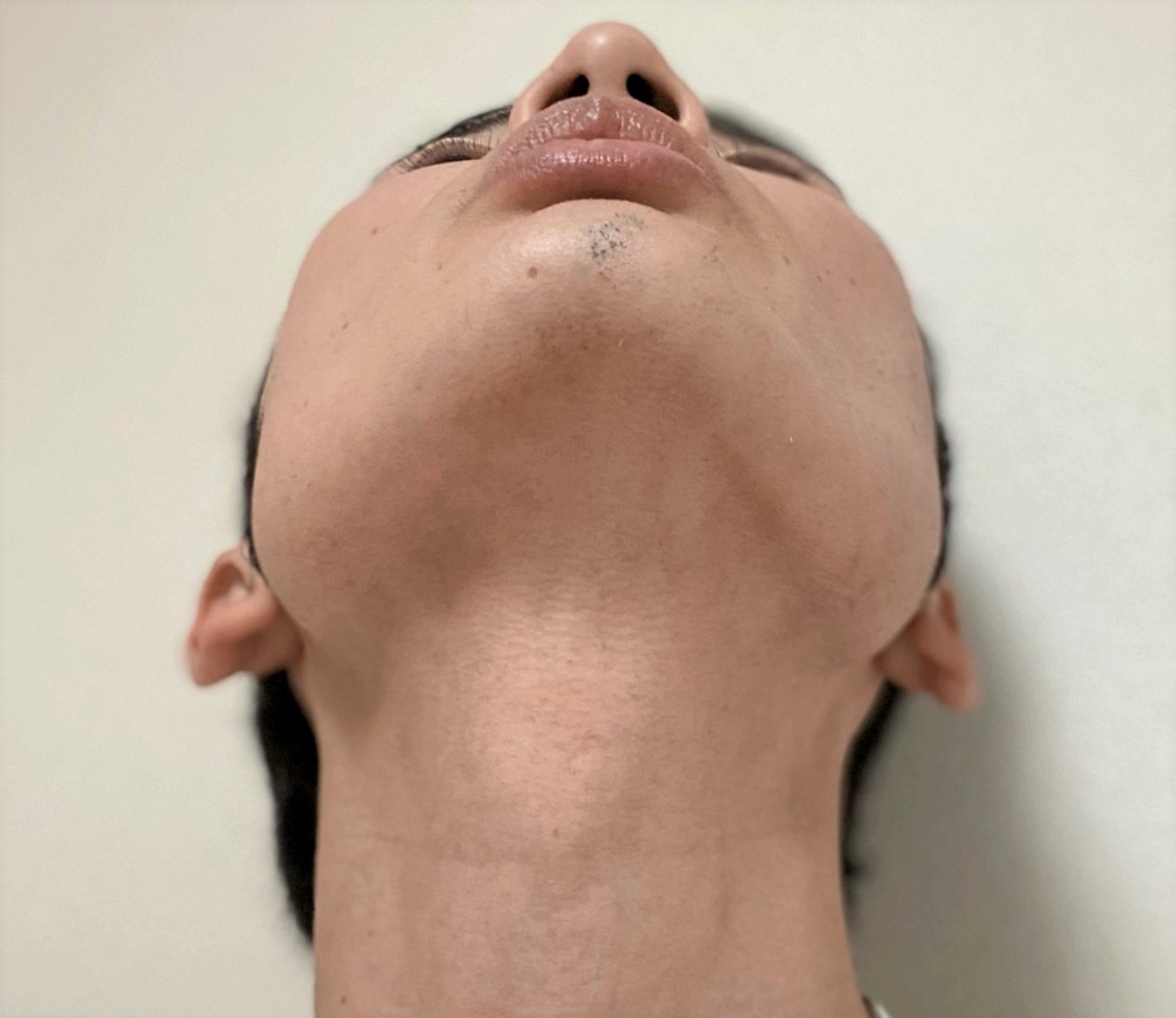 ヒゲ脱毛でツルツルになるまで