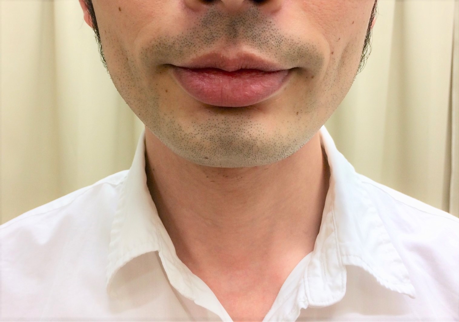 ヒゲ脱毛でツルツルになるまで